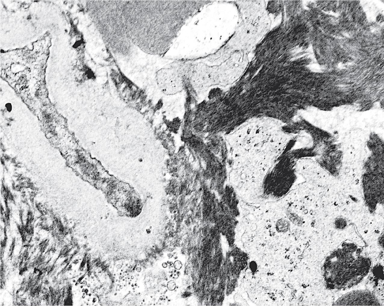 FIG. 4.38, Thrombotic microangiopathy.