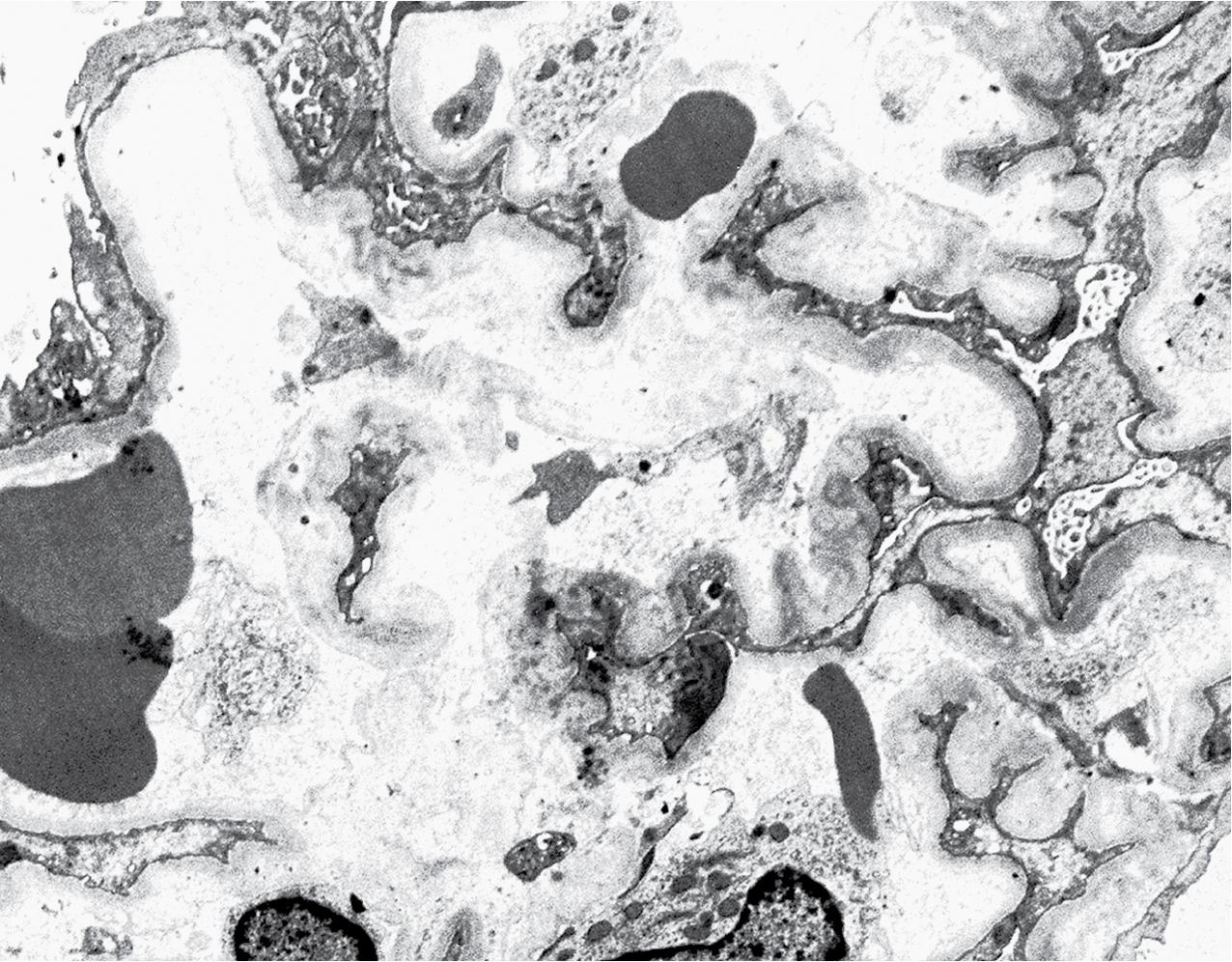 FIG. 4.37, Thrombotic microangiopathy.