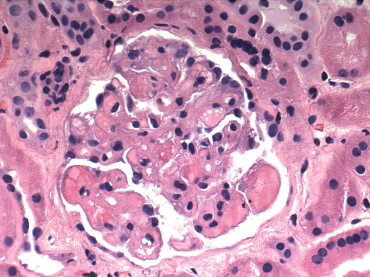 FIG. 4.41, Thrombotic microangiopathy.