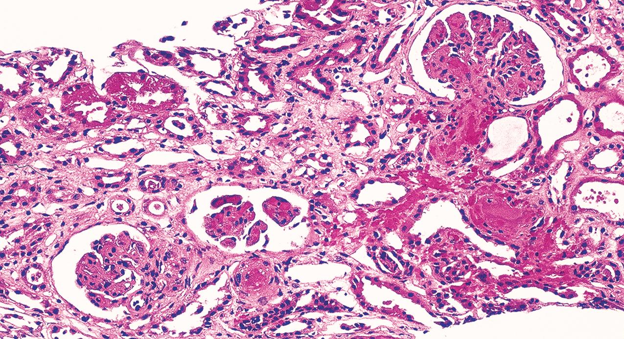 FIG. 4.43, Scleroderma.