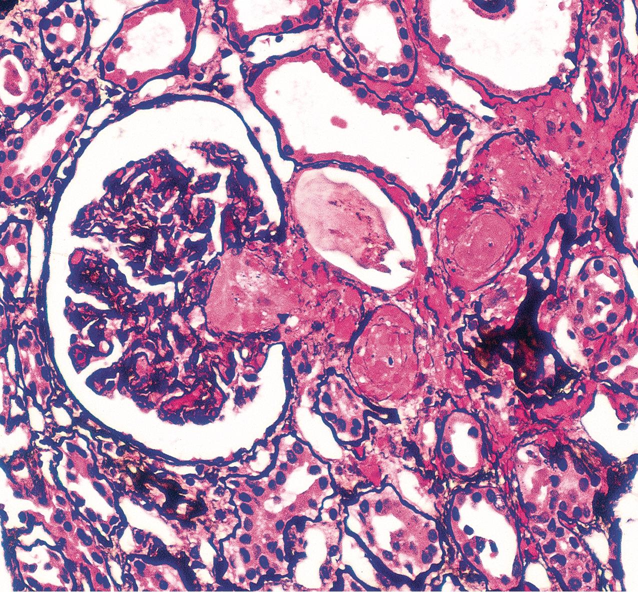 FIG. 4.44, Scleroderma.