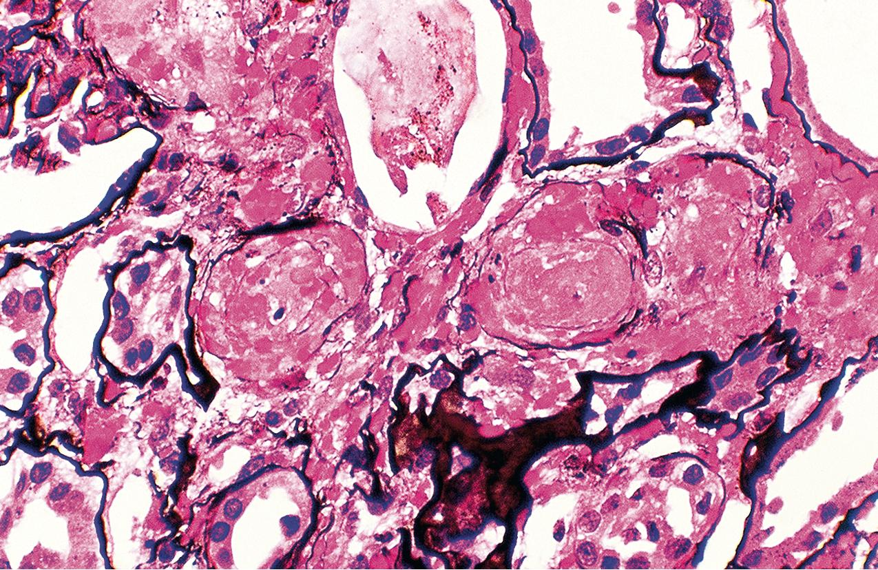 FIG. 4.46, Scleroderma.