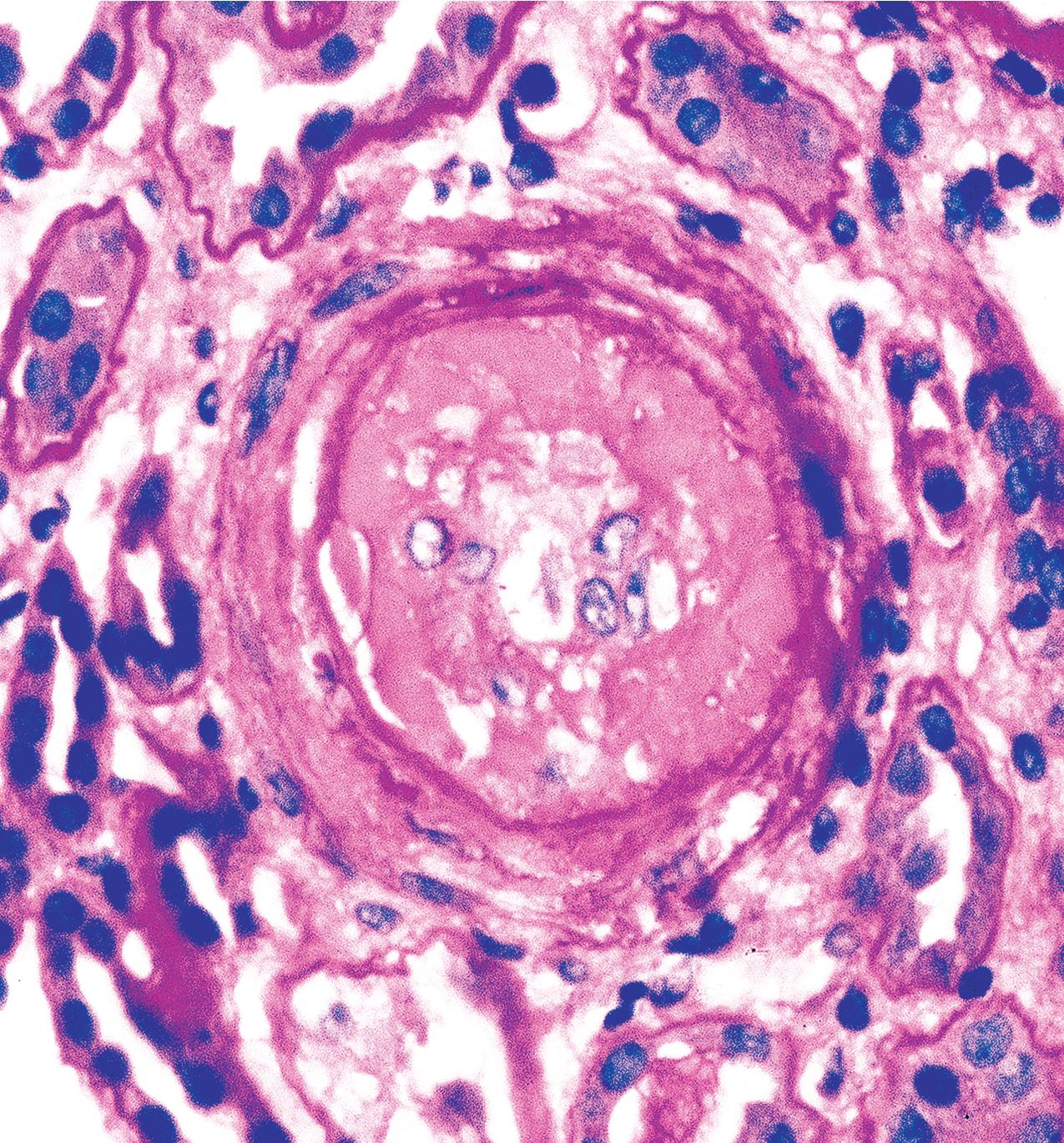 FIG. 4.49, Scleroderma.