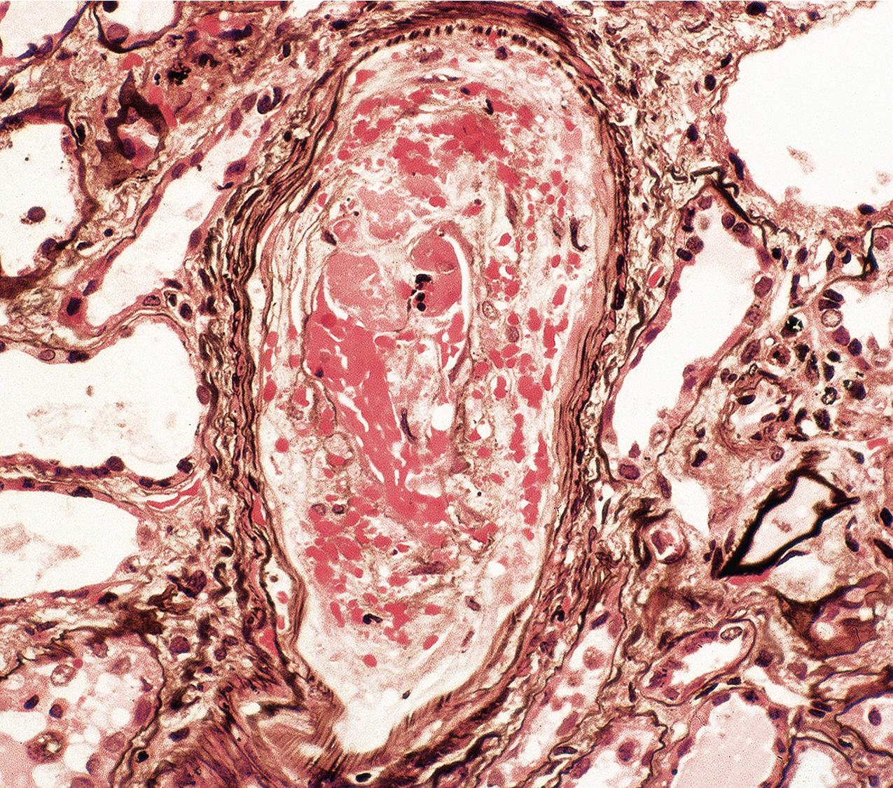 FIG. 4.48, Scleroderma.