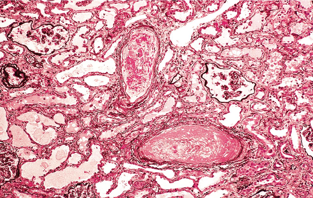 FIG. 4.47, Scleroderma.