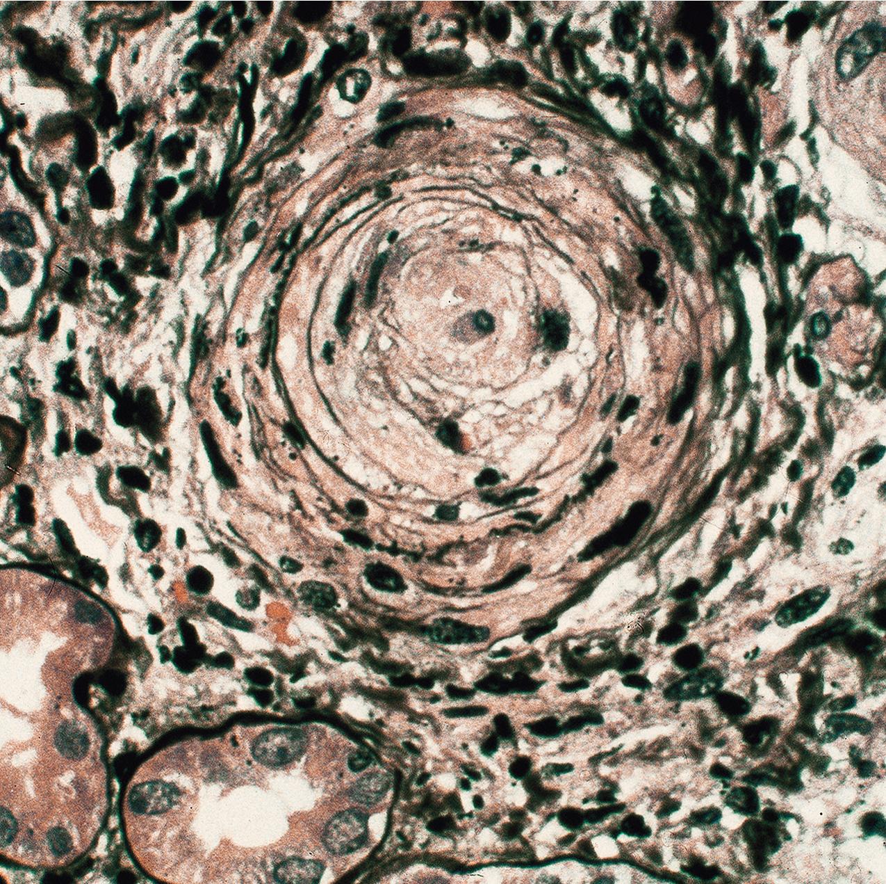 FIG. 4.53, Scleroderma.