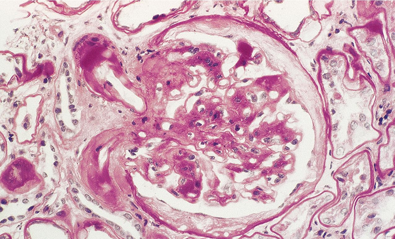 FIG. 4.3, Diabetic nephropathy.