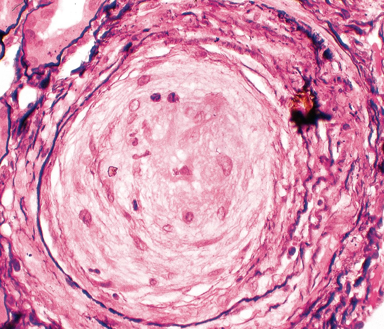 FIG. 4.52, Scleroderma.