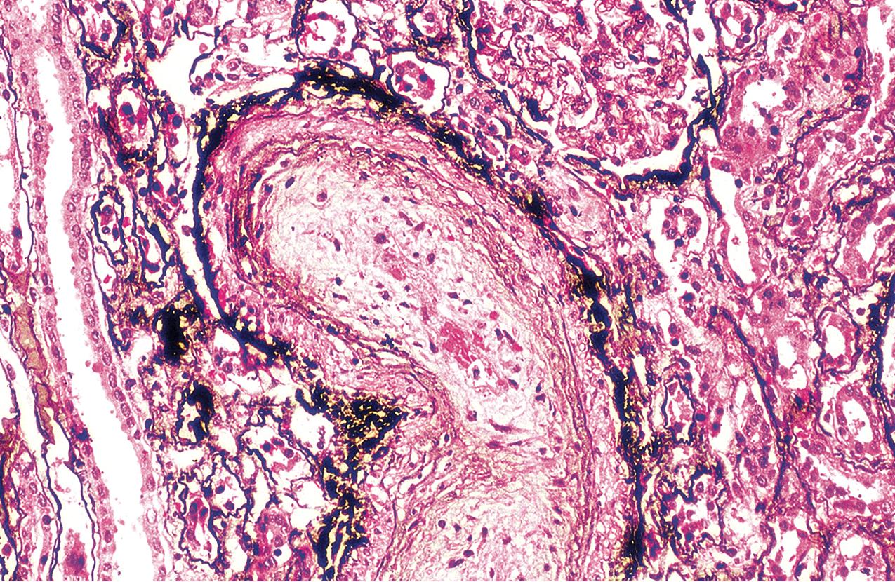 FIG. 4.50, Scleroderma.