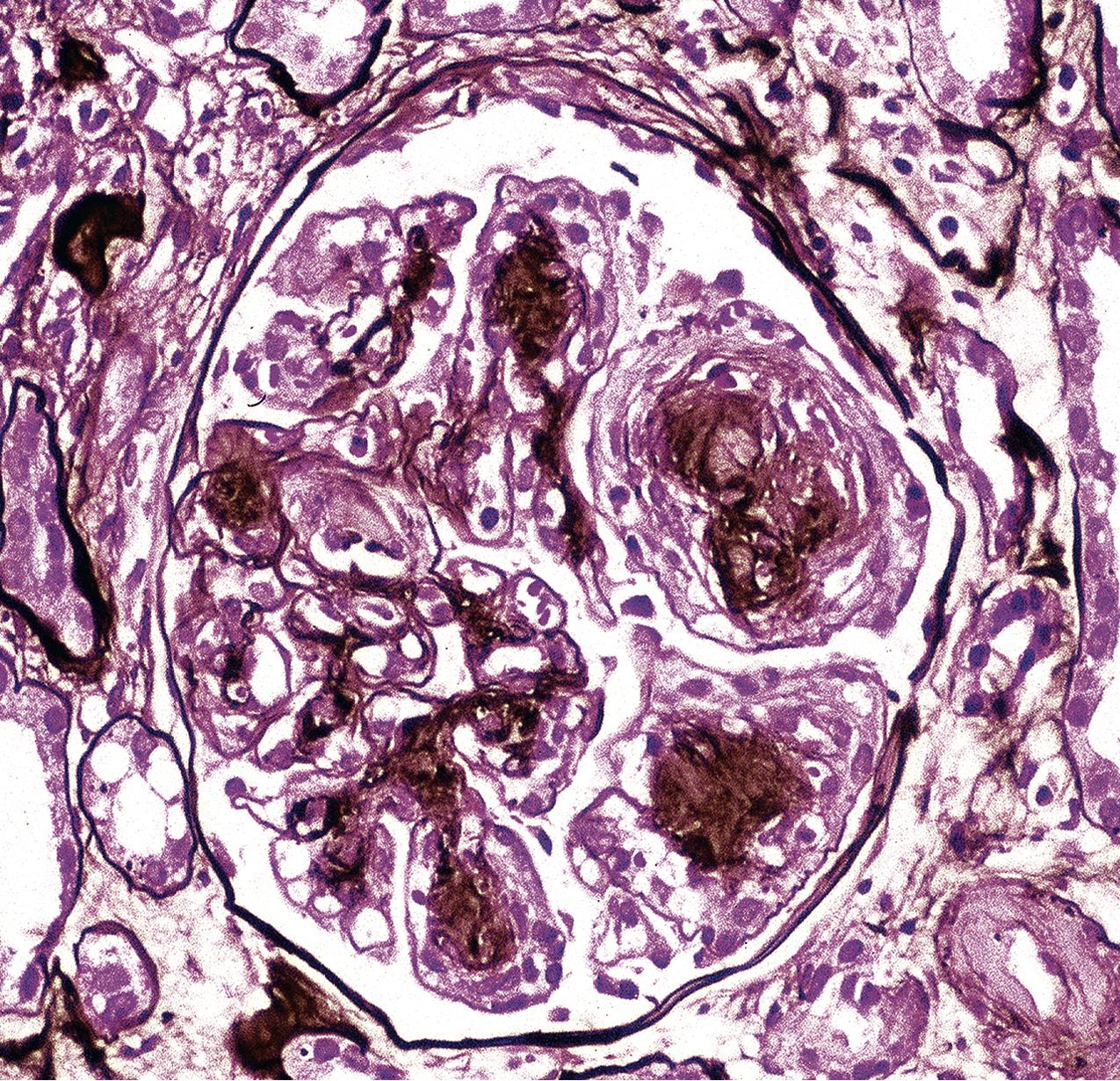 FIG. 4.6, Diabetic nephropathy.