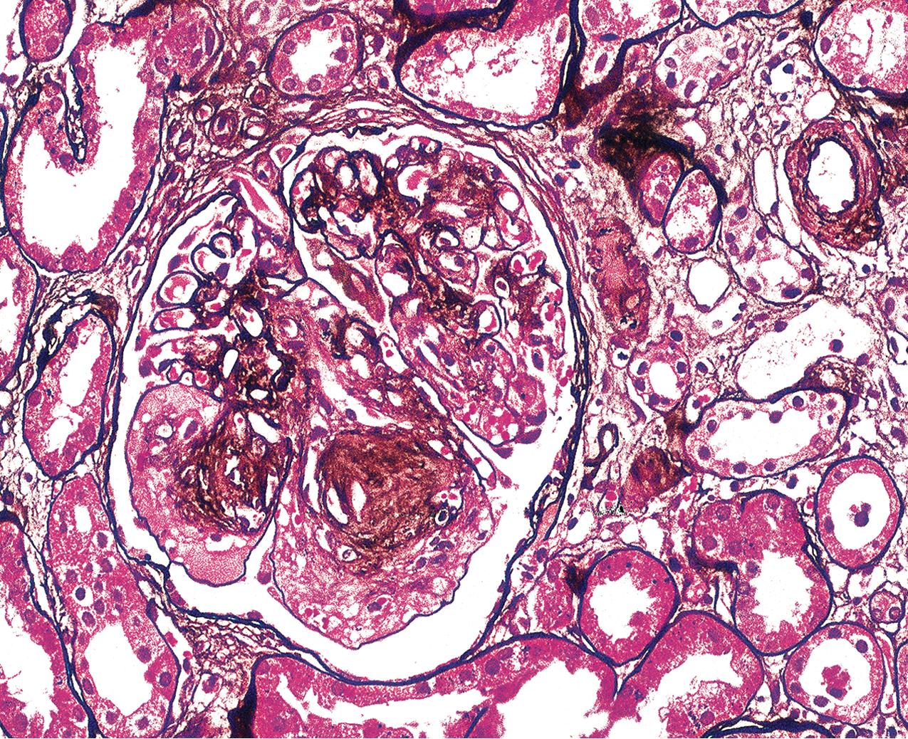 FIG. 4.7, Diabetic nephropathy.