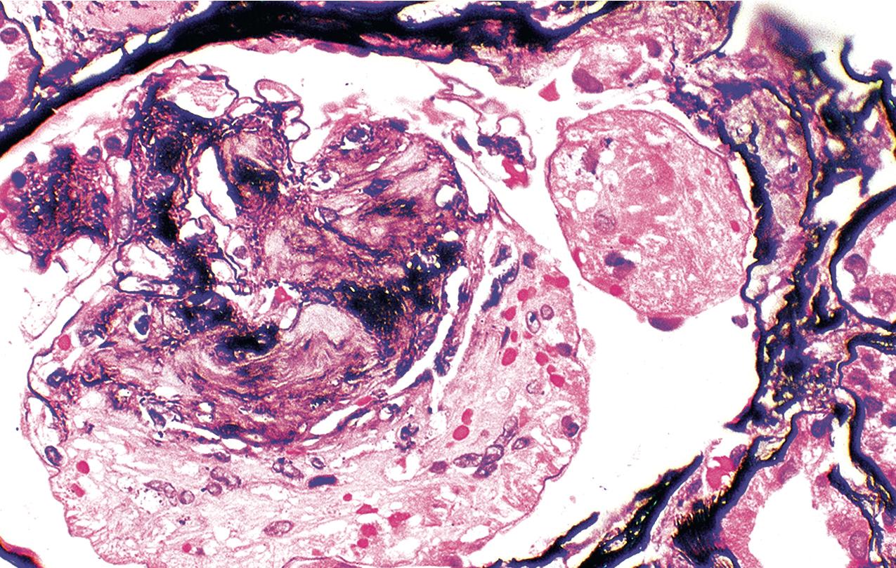 FIG. 4.8, Diabetic nephropathy.