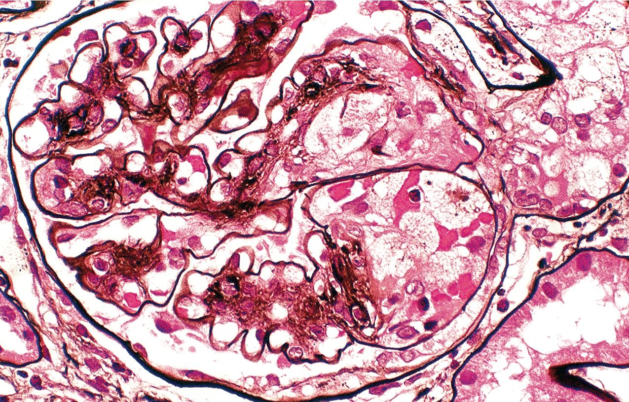 FIG. 4.9, Diabetic nephropathy.