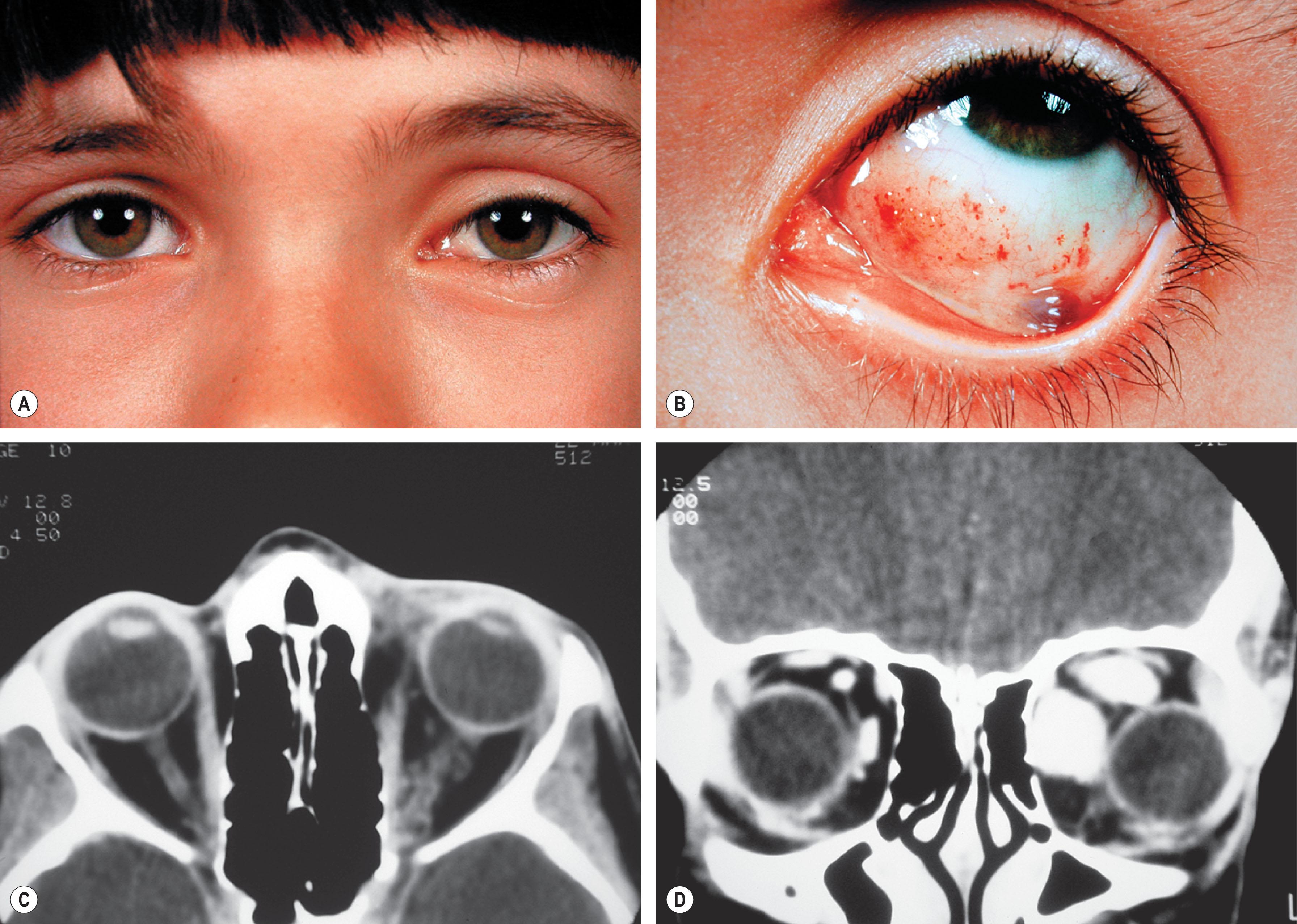 Fig. 20.1, (A) This 12-year-old child presented with an epibulbar lesion on the left side associated with fullness of the upper and lower lids and slight ptosis. (B) The epibulbar surface demonstrates a gelatinous-appearing lesion medially containing many clear fluid-filled cysts along with focal blood cysts, many of which appear to have menisci. In addition, in the inferolateral fornix, there appears to be a dark varix. The conjunctival lesion was proven on biopsy to be consistent with a venous-lymphatic malformation histologically and by electron microscopy. It was noted also that the superior sulcus appeared somewhat deepened on the left. (C) Post-contrast axial CT scan shows an irregular lesion occupying the anteromedial orbit around and behind the caruncle. On direct coronal view (D), there is evidence of a posterior orbital varix that appeared with increased venous pressure. This lesion represents a combined venous-lymphatic malformation and varix.