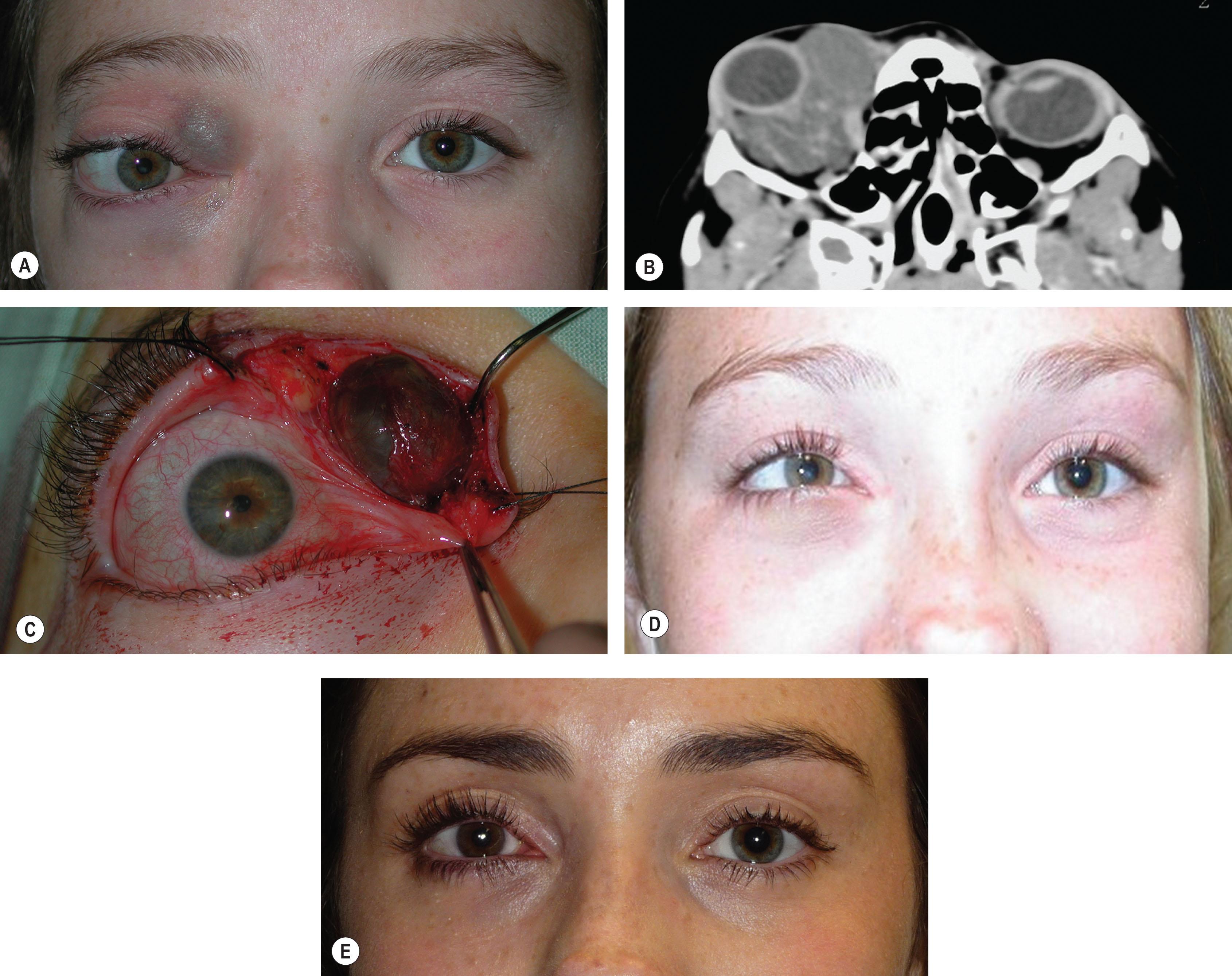 Fig. 20.2, (A) A 6-year-old girl with an extensive macrocystic lymphatic-venous malformation (LVM) of the right orbit. (B) An axial CT scan shows the lesion involving both extra- and intraconal spaces. (C) An upper lid split orbitotomy to excise the superomedial component. An inferolateral orbitotomy was also performed to debulk both extra- and intraconal components. (D) At 3 months follow-up there is marked reduction in proptosis, but with strabismus, subsequently managed surgically. (E) Late follow-up at age 24 years with well-preserved vision and no proptosis.