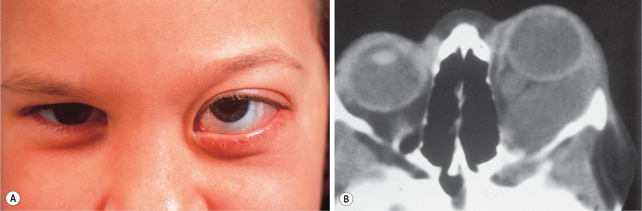 Fig. 20.3, Orbital venous-lymphatic malformation (lymphangioma). (A) Sudden onset of proptosis in the left eye of a previously asymptomatic 5-year-old child. (B) CT scan shows diffuse soft tissue density lesion arborizing through the retrobulbar tissues.