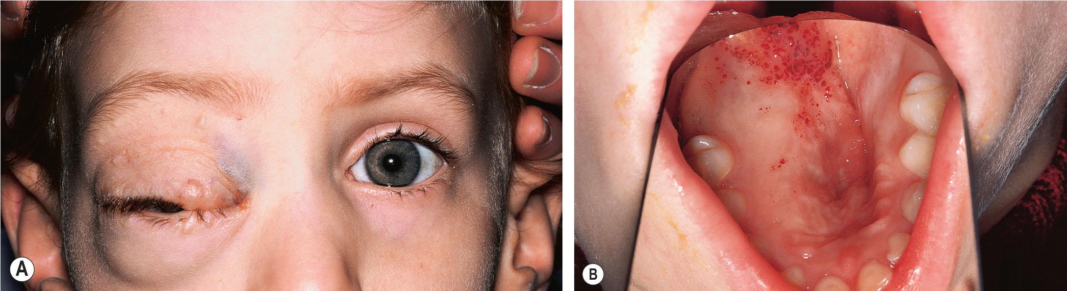 Fig. 20.4, (A) This 4-year-old boy was born prematurely at 32-weeks’ gestation. Right proptosis developed by 4 weeks and was progressive despite orbital surgery, until the age of 3 years. It has been static since then. The diagnosis was a venous-lymphatic malformation. (B) Same patient showing clear and blood-filled cystic lesions on the palate.