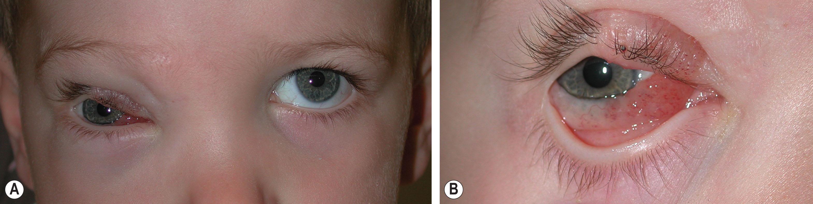 Fig. 20.5, (A) A 2-year-old boy with an extensive deep lymphatic-venous malformation of the right orbit has involvement of the medial right upper eyelid skin and conjunctiva. (B) Microcystic lymphatic components are seen on the medial upper eyelid and on the bulbar conjunctiva.