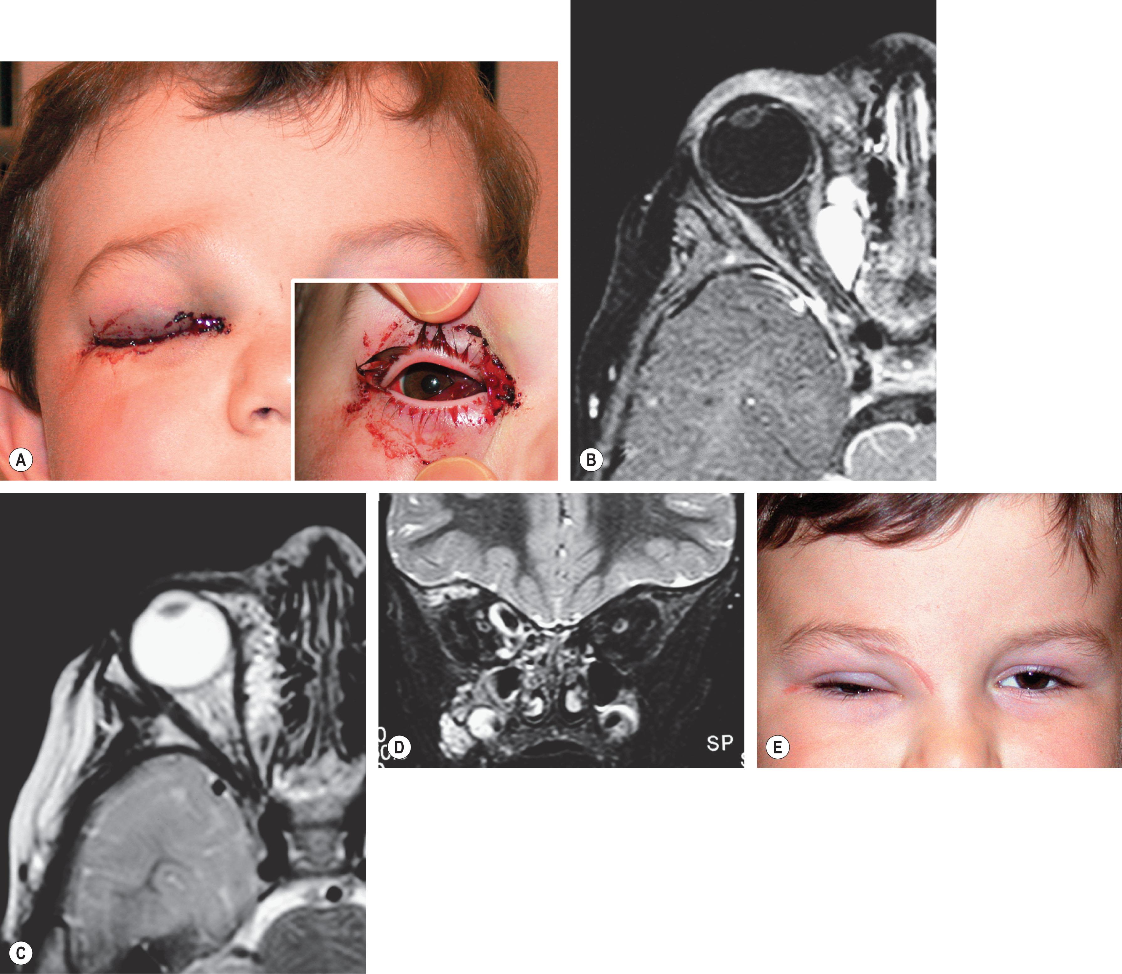 Fig. 20.6, (A) This 2½-year-old boy was born with a swollen right eye. At age 1, he developed spontaneous bruising and a gelatinous lesion on the surface of the right globe, treated at the time with steroids with improvement. He continued, however, to have constant bleeding from the epibulbar surface, progressive lid closure, and swelling. (B–D) MRI scans demonstrate an extraconal medial lesion that involves the lid and forehead and extends to the apex of the right orbit. Posteriorly, note the cystic components consistent with venous-lymphatic malformation. The patient underwent excision of his venous-lymphatic malformation. (E) He did well postoperatively (seen here at 1 month following surgery), with a residual ptosis and persistent lid involvement, which will require future surgery.