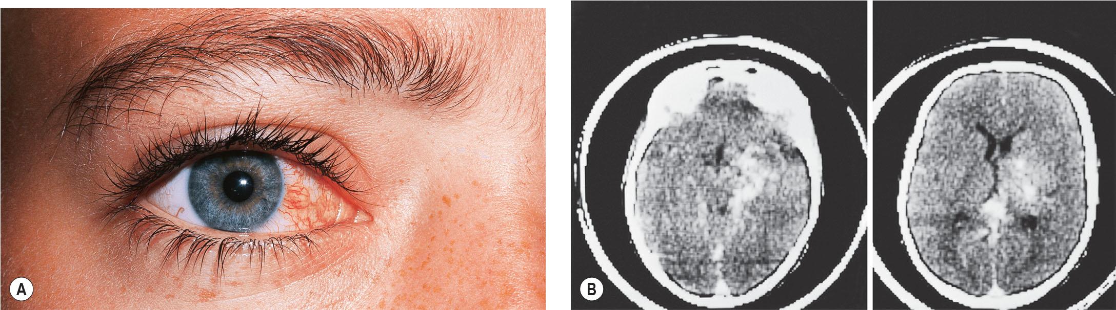 Fig. 20.7), ( A) Subconjunctival varicosities in a patient with an orbital and intracranial hemangioma. (B) Contrast-enhanced CT scans showing the intracranial lesion (same patient).