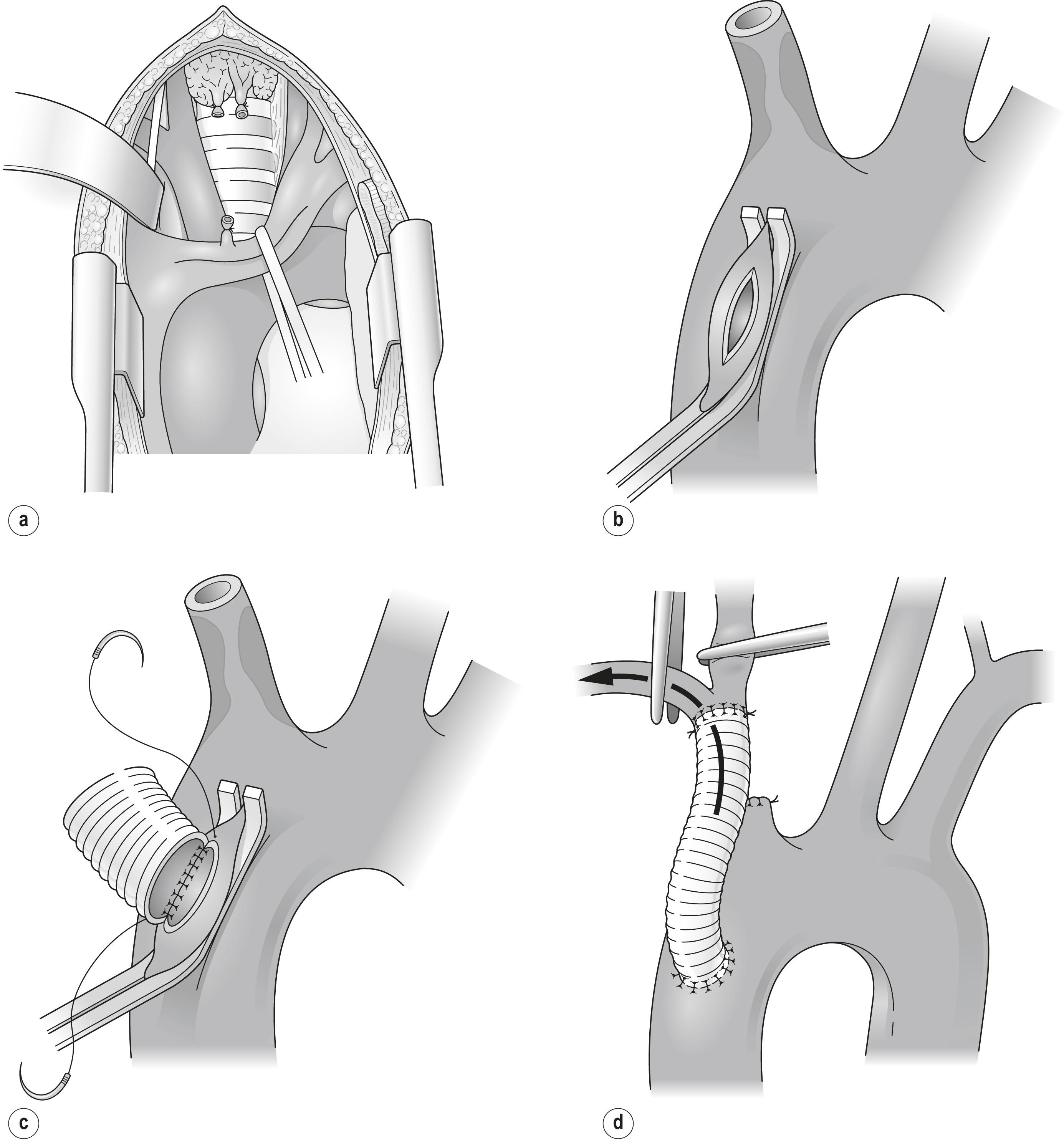 Figure 11.1, (a) The left brachiocephalic vein is retracted to expose the brachiocephalic artery. (b) A clamp is applied laterally to the ascending aorta. (c) A polyester graft is implanted on the ascending thoracic aorta proximal to the brachiocephalic artery. (d) Completed bypass. Flow is released into the arm and then into the common carotid artery.