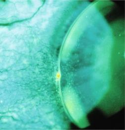 Fig. 16.1, Grade 1 vascularised limbal keratitis viewed in cobalt blue light with fluorescein instilled.