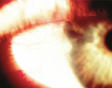 Fig. 16.2, Grade 2 vascularised limbal keratitis (VLK).