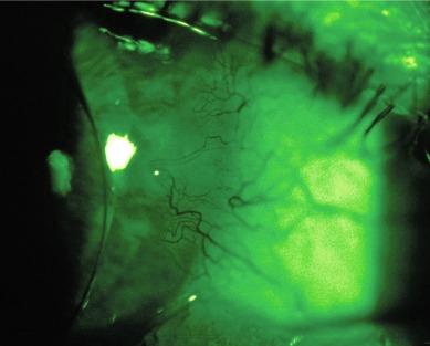 Fig. 16.3, Grade 3 vascularised limbal keratitis (VLK) viewed in red-free (green) light.