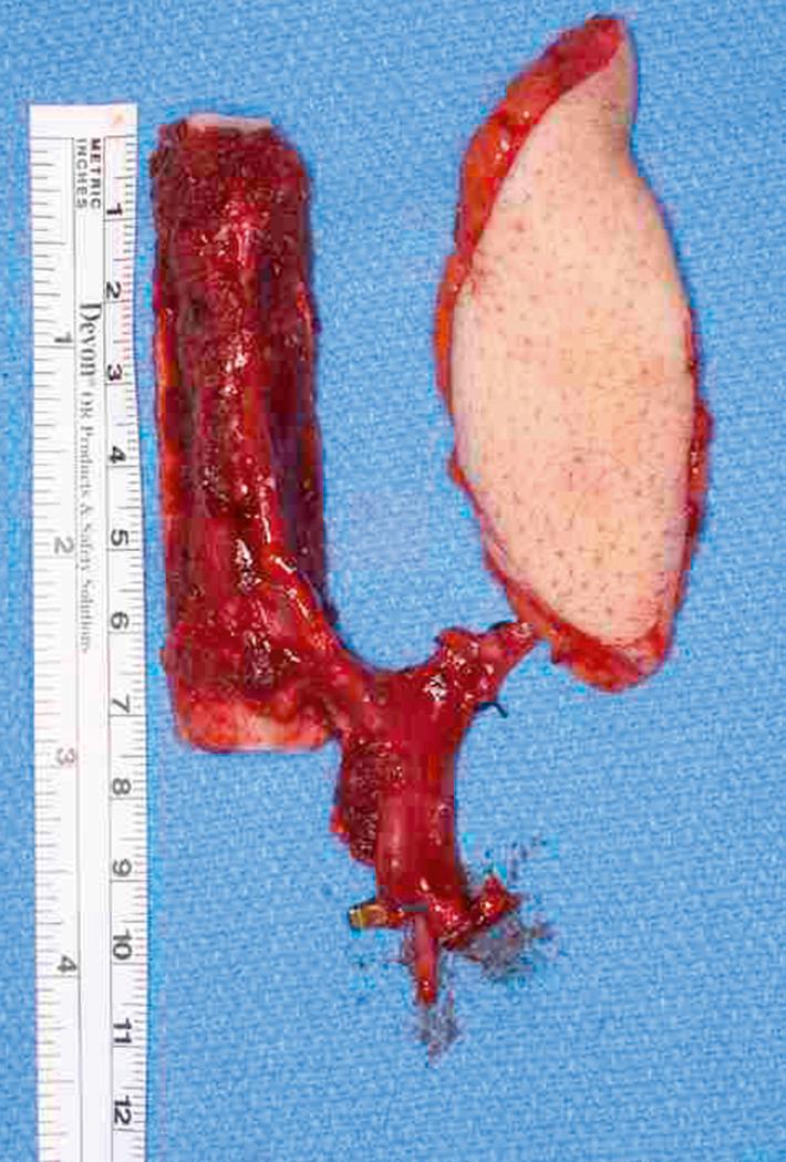 Fig. 46.1, Osteocutaneous fibula. The fibula may be harvested as a composite flap including skin for coverage or monitoring purposes.