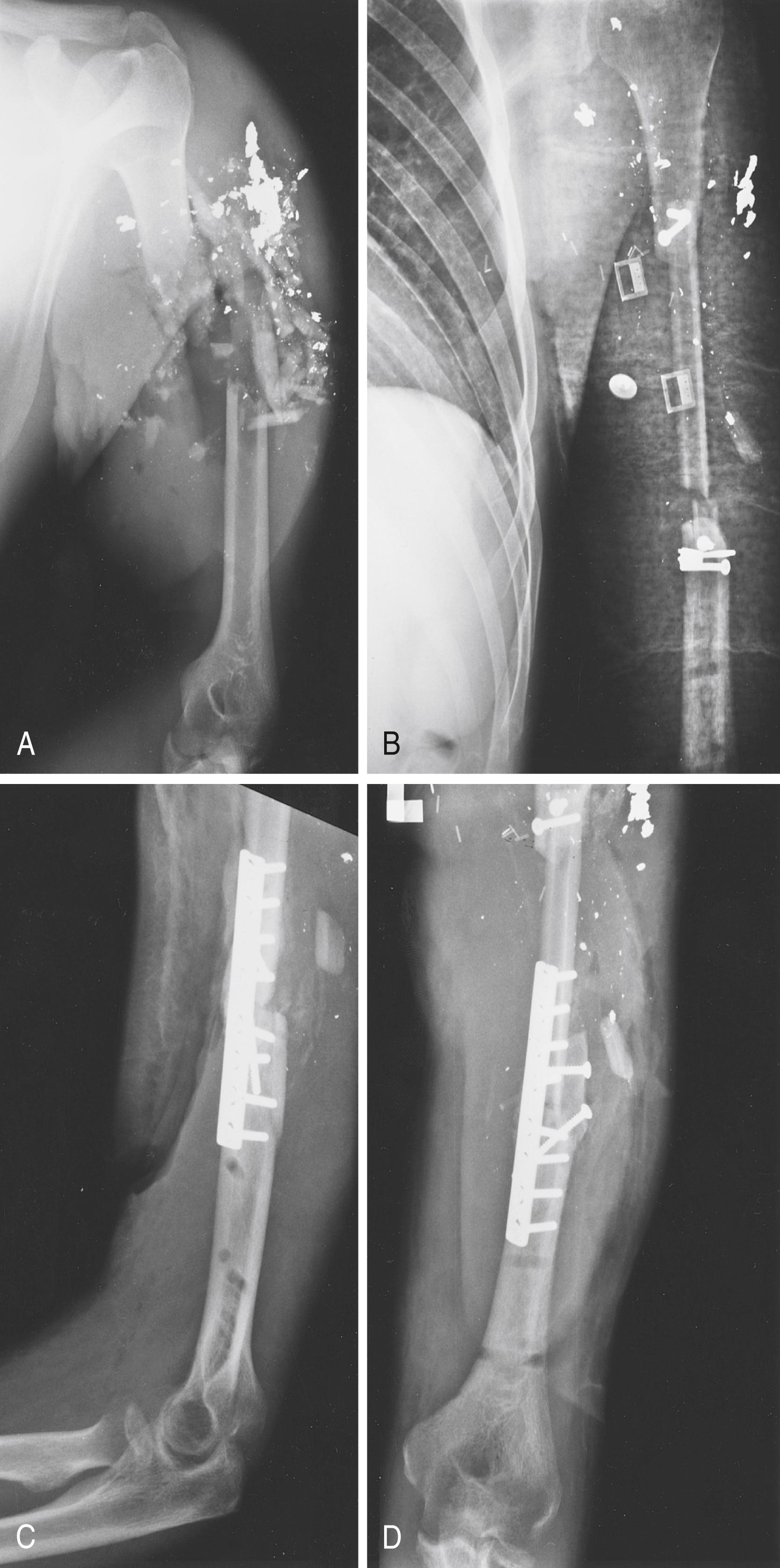 Fig. 46.3, Gunshot wound in a 23-year-old man. A, Fragmentation of the humeral diaphysis before debridement. A large anterior wound was closed with a pedicled latissimus dorsi flap placed as an elbow flexorplasty to replace the missing biceps. B, A simultaneous fibular graft reconstructed the bone defect. A stress fracture occurred shortly after removal of a bridging external fixator several months later. C and D, Supplemental onlay bone grafting a plate fixation allowed healing of the fibula.