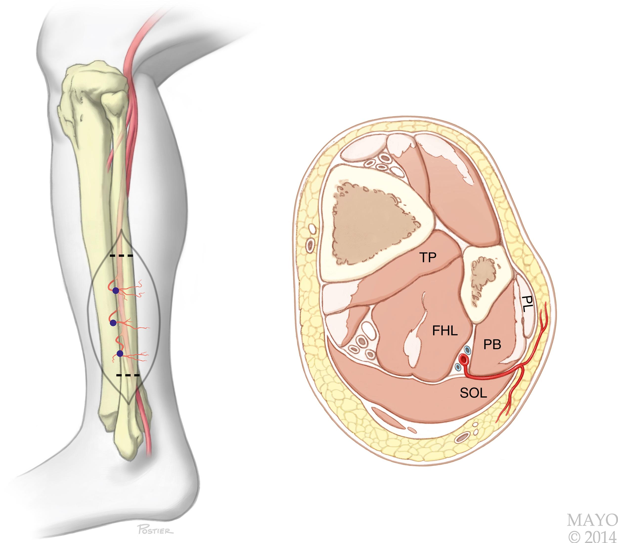 Fig. 46.4, Harvest of a fibular free bone graft is performed from a lateral approach. The initial dissection is between the peroneus longus and the soleus. In this middle-third cross-sectional view, the peroneal vessels lie between the flexor hallucis longus and the tibialis posterior muscles. EDL, Extensor digitorum longus; EHL, extensor hallucis longus; FHL, flexor hallucis longus.