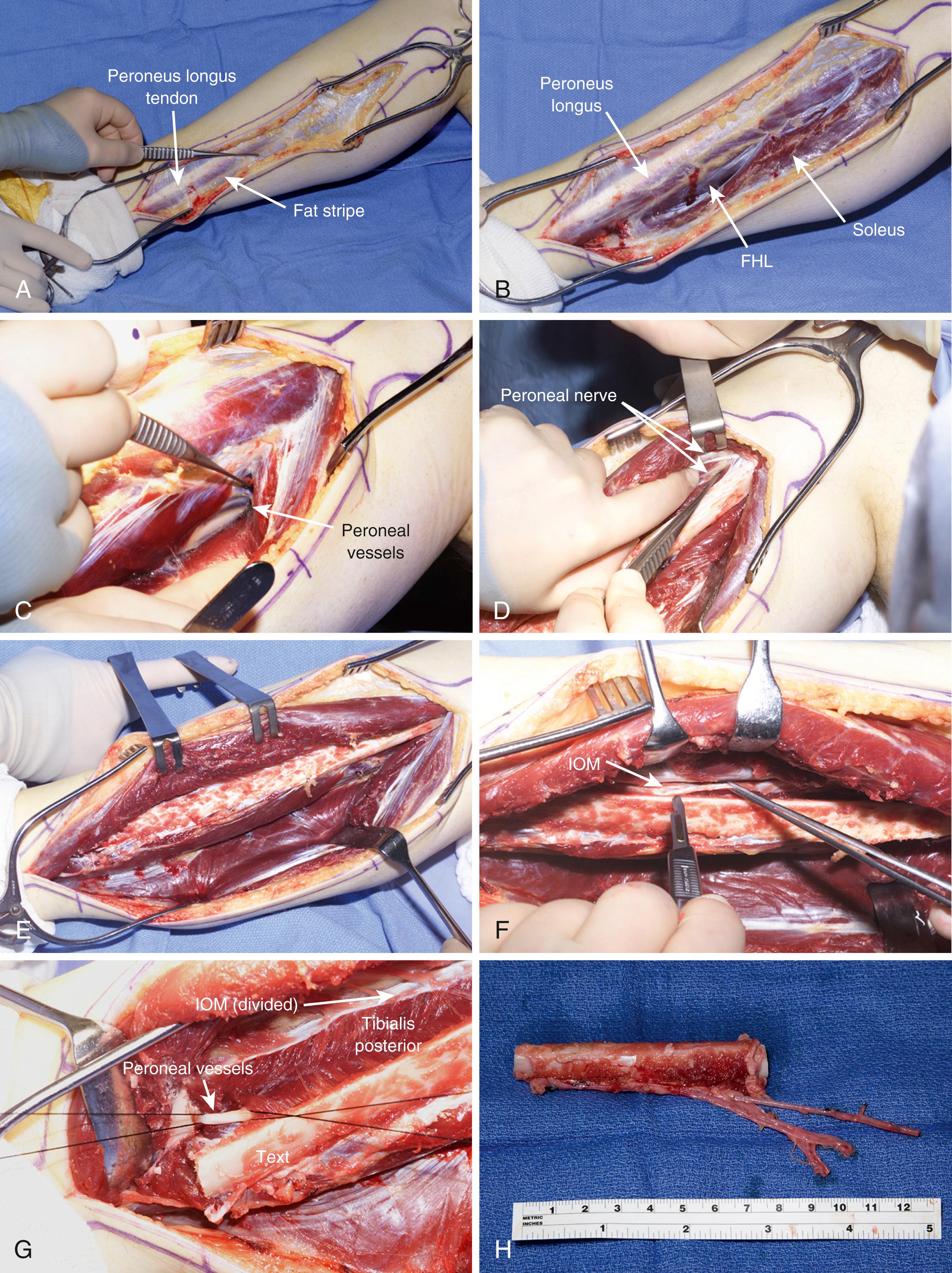 Fig. 46.5, Technique of fibula harvest. See description in text. A, The fat stripe dorsal (posterior) to the peroneus longus tendon marks the plane of the initial dissection. B, Open the soleus/peroneus longus interval at midtibia, remaining superficial to the flexor hallucis longus (FHL). C, Follow the FHL on posterior surface of fibula to its proximal origin. The peroneal vessels will then be visualized passing anterior to the muscle. D, Begin the anterior portion of the dissection. Identify and protect the peroneal nerve, including both superficial and deep branches, by proximal subperiosteal dissection at the fibular neck. E, Dissection then proceeds superficial to the periosteum distally to preserve periosteal vessels, elevating the lateral and anterior compartment muscles. F, The interosseous membrane is divided from the anterior aspect, exposing the tibialis posterior muscle. G, The proximal and distal fibular cuts are made, protecting the peroneal vessels and nerve. The peroneal vessels are visualized and ligated distally, located between the FHL and the tibialis posterior. The tibialis posterior muscle is released from the fibula beginning distally, thus exposing the peroneal vessels. Similar release of the FHL completes the dissection. It is necessary to identify and ligate multiple muscular branches with meticulous dissection. H, The fibula harvest is complete, including its proximal peroneal vessel pedicle and including the artery and two venae comitantes.