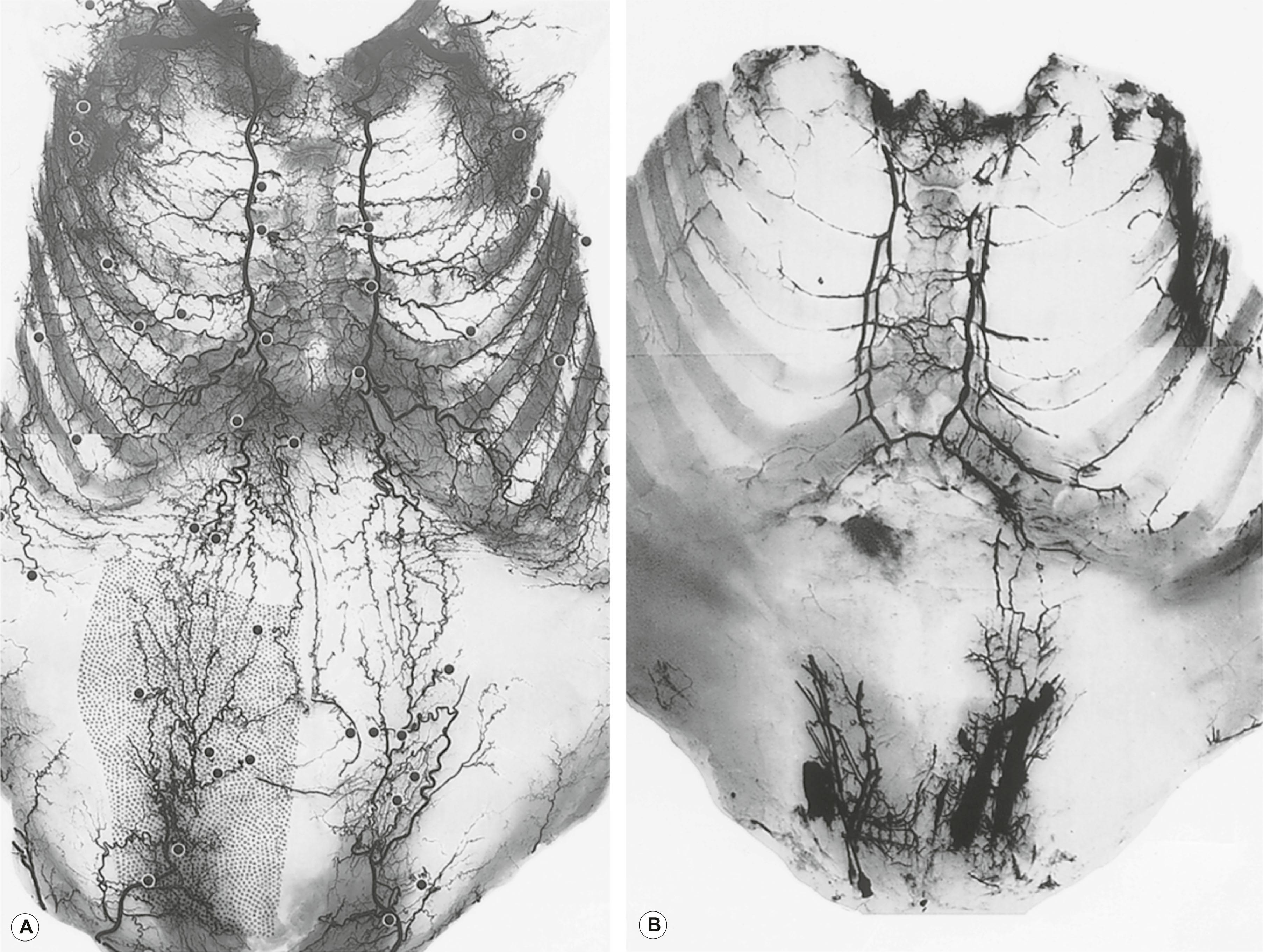 Figure 23.13, (A) Arterial and (B) venous studies of the anterior torso. Note the “corkscrew” choke arteries that link adjacent territories in the arterial study and the mixture that has extruded from the deep inferior epigastric veins as a result of the resistance of the valves. Radiographic lead beads identify the origin of the cutaneous perforators from their source vessels in the arterial study.