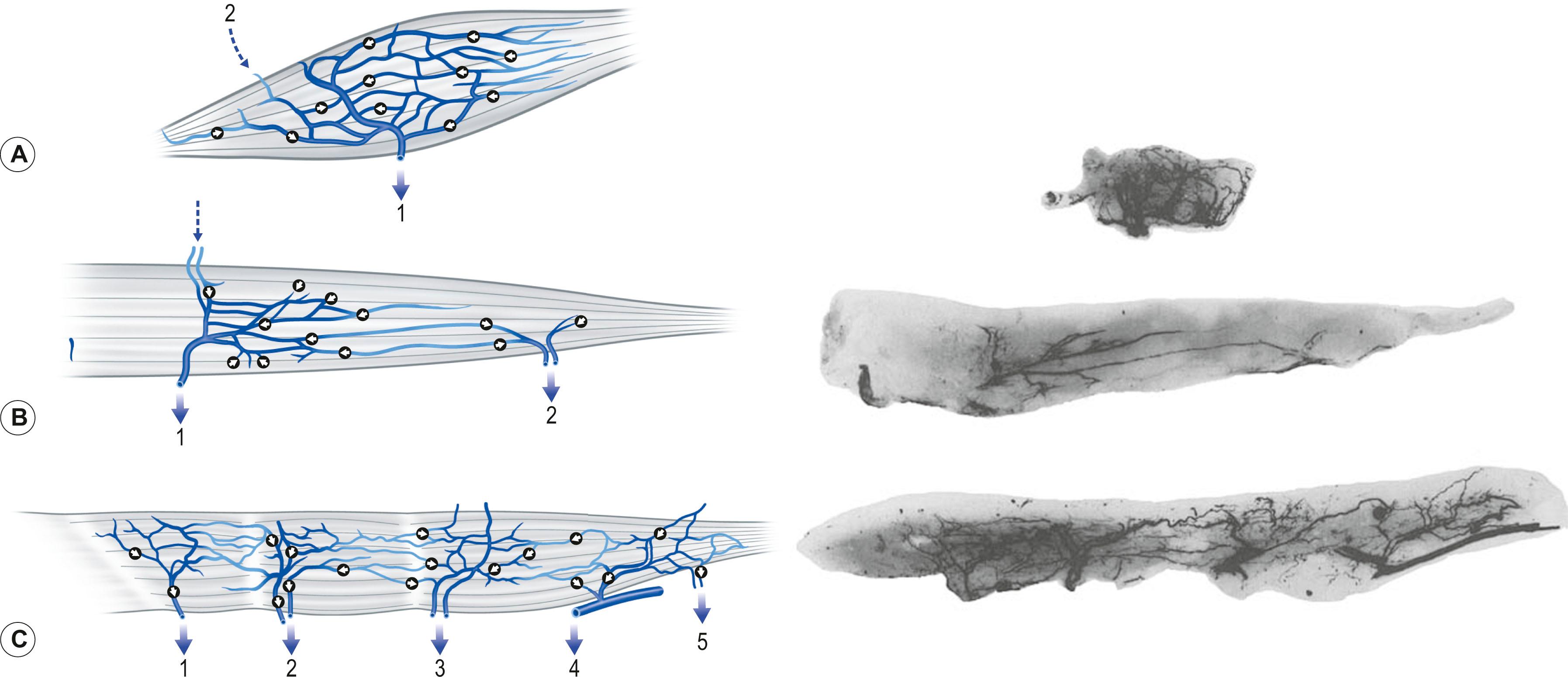 Figure 23.14, Illustrations and radiographs of venous injection studies of the supraspinatus (A) , gracilis (B) , and sartorius (C) muscles. Note the oscillating veins that separate them into type I, II, and III muscles and the efferent veins entering the supraspinatus and gracilis muscles (dashed arrows).