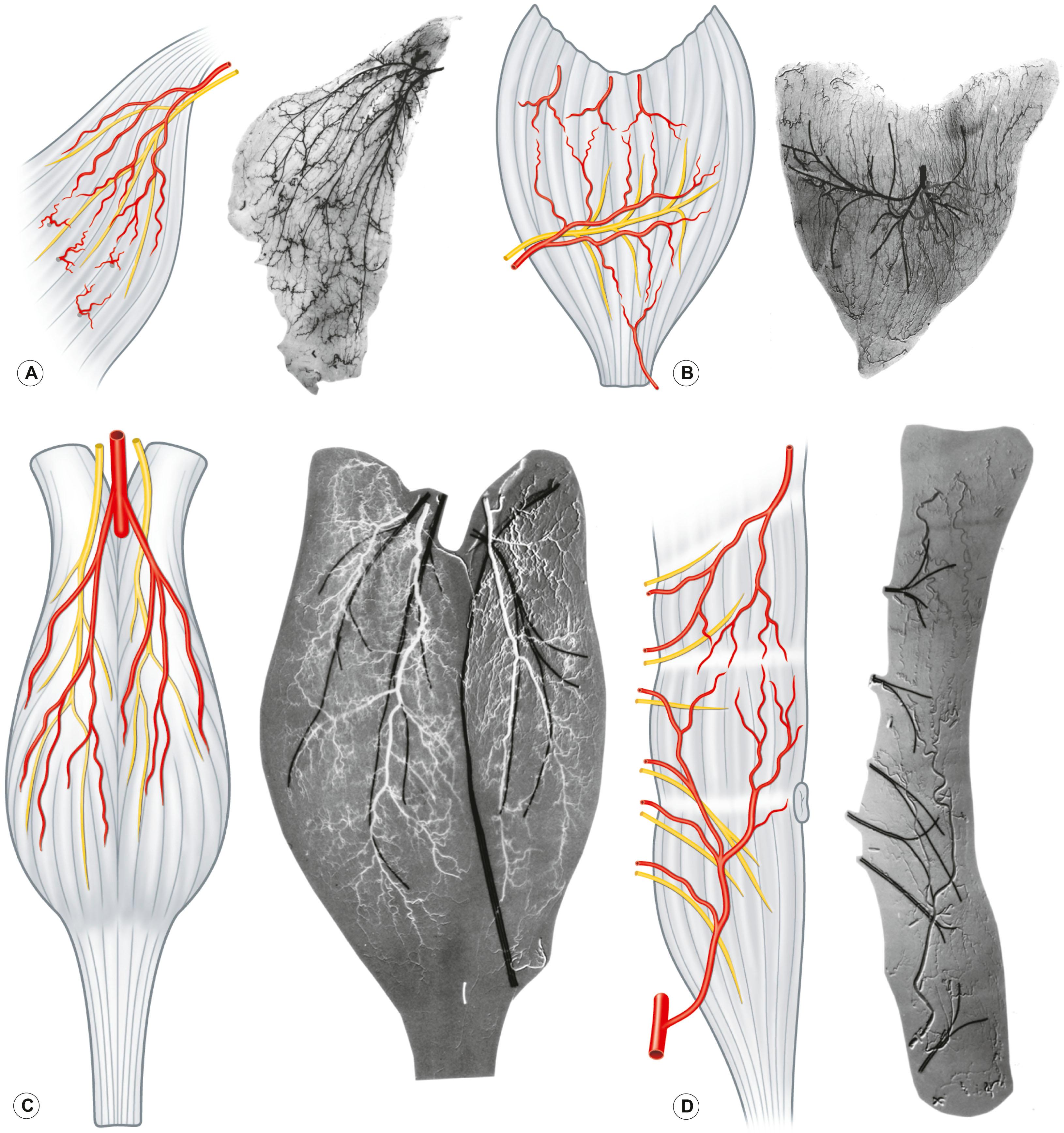 Figure 23.18, Schematic diagram (left) of (A) type I (latissimus dorsi), (B) type II (deltoid), (C) type III (gastrocnemius), and (D) type IV (rectus abdominis) muscles to match radiograph (right) of each muscle. Nerves and vessels are seen together in the radiographs. The nerves are straight, whereas the vessels are spiral. The nerves, labeled with computer wire, appear black and the vessels pale and “ghost-like” in this subtraction study.