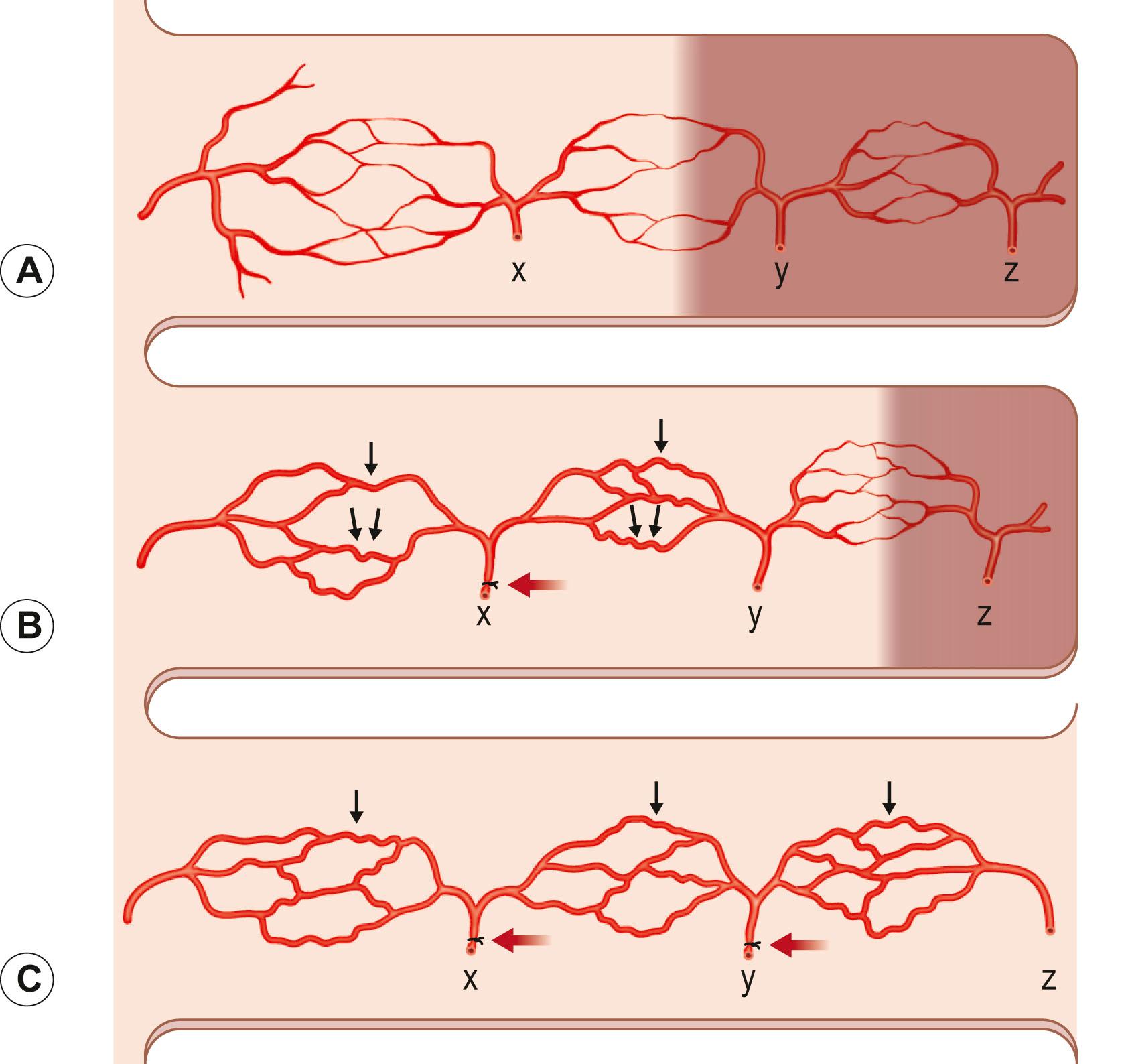 Figure 23.53, Diagrammatic representation of the same flap raised with and without a surgical delay to illustrate the necrosis line and the changes in the choke vessels. (A) The adjacent territory x is captured with safety, and the necrosis line occurs at the choke–vessel interface with vessel y or the one beyond. (B) Vessel x had been delayed. Note the effect on the choke vessels and the site of the necrosis line. (C) Vessels x and y have been delayed in this bipedicled flap. Vessel z is divided and the tip of the flap elevated at a second stage to provide the longest flap.