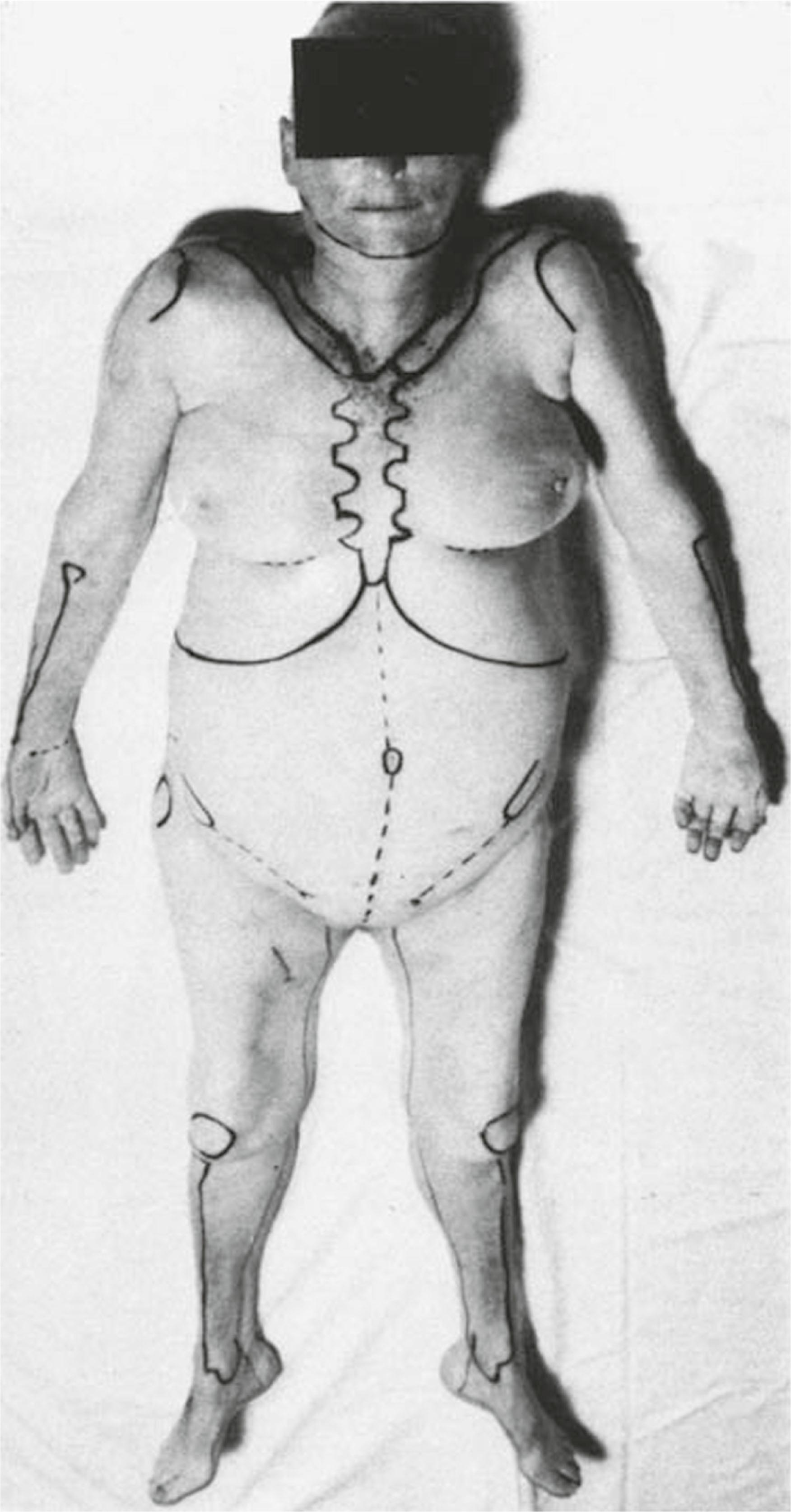 Figure 23.5, Cadaver with body landmarks and incision lines marked.