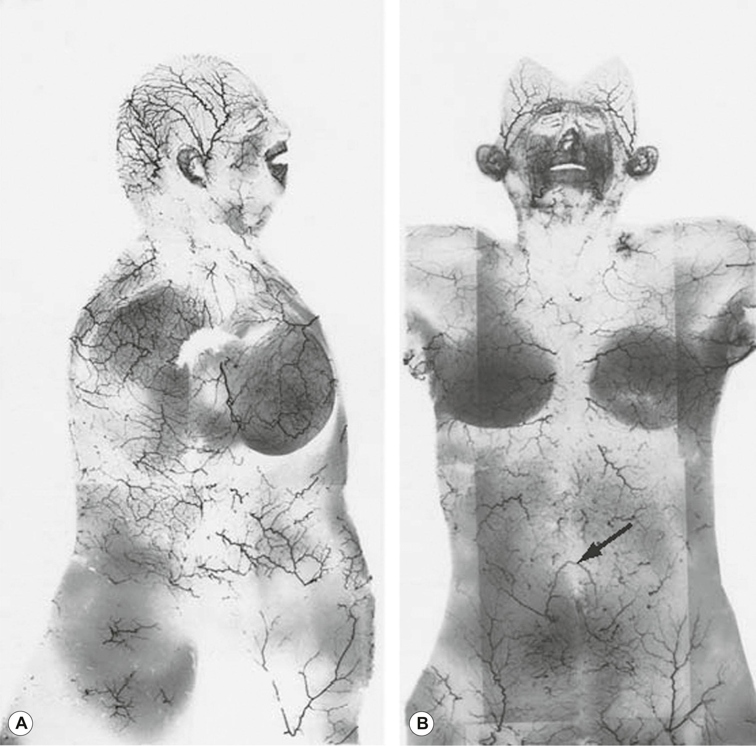 Figure 23.6, Lateral view of one female subject ( A ) and anterior view of another ( B ). ( A ) The arm has been removed. Note the network of large vessels that sweep laterally from the ventral and dorsal midlines, ascend from the groins, descend from the shoulder girdle, and converge on the summits of the scalp and the breasts. This demonstrates the principle that vessels radiate from fixed concave zones and radiate to mobile convex areas. ( B ) A lower midline scar interrupts the vessels with compensatory opening of a large choke vessel above the umbilicus (arrow) to re-establish the flow across the midline.