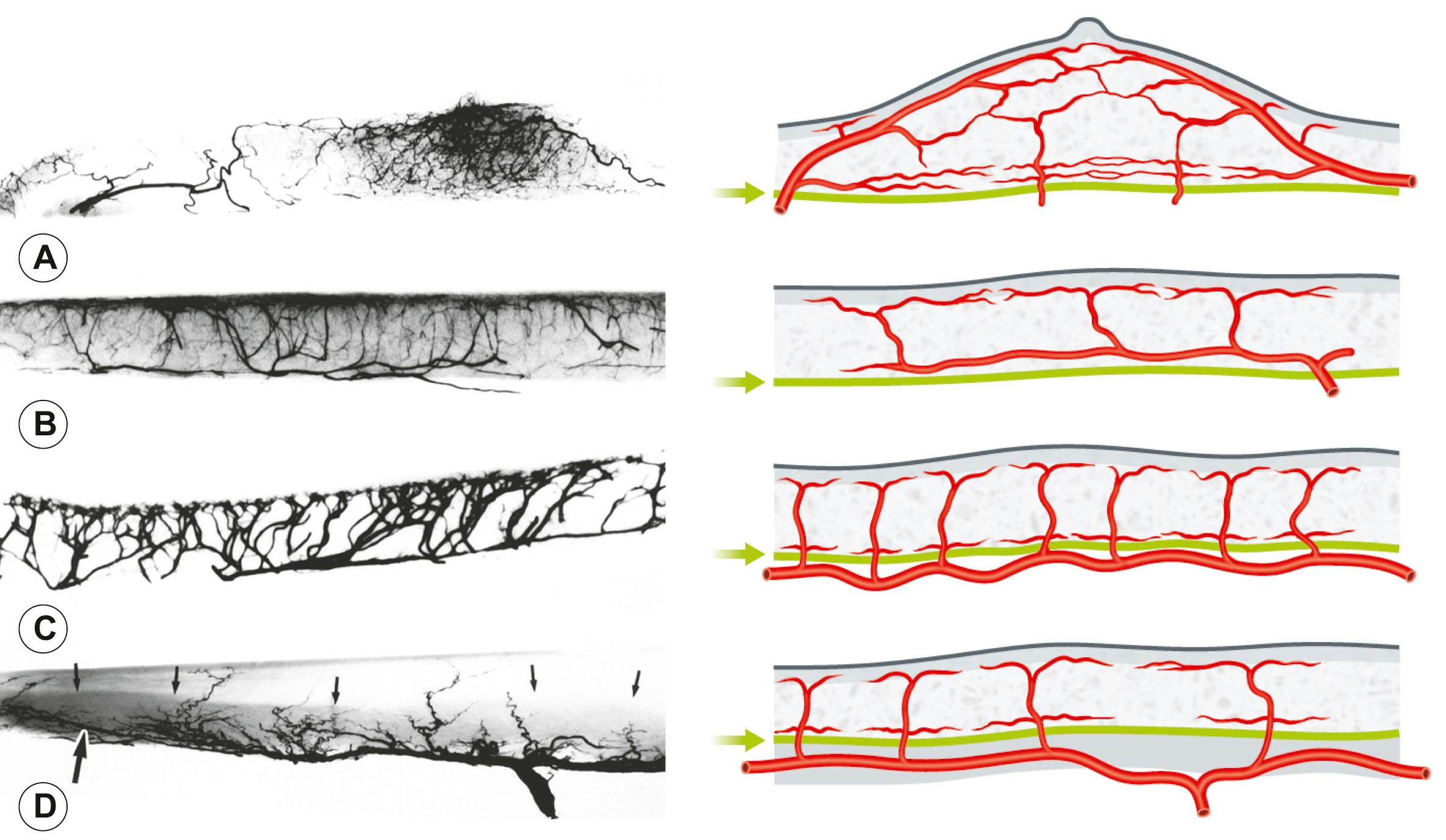 Figure 23.8, Sectional strip radiographic studies of the breast (A) , thigh (B) , sole of the foot (C) , and buttock (D) . (D) includes the underlying gluteus maximus muscle. The schematic diagram illustrates the dominant horizontal axis of vessels that provides the primary supply to the skin in each case and its relationship to the deep fascia (arrow). (A) They predominate in the subdermal plexus. Note from left to right the internal thoracic perforator and lateral thoracic artery converging on the nipple in the radiograph of the loose skin region of the torso. (B) They are seen coursing on the surface of the deep fascia in this relatively fixed skin area. (C) The source artery itself is the dominant horizontal vessel supplying the skin, coursing beneath the deep fascia in this rigidly fixed skin region. (D) Small arrows define the deep fascia, and the large arrow indicates the large fasciocutaneous branch of the gluteal artery, which descends with the posterior cutaneous nerve of the thigh.