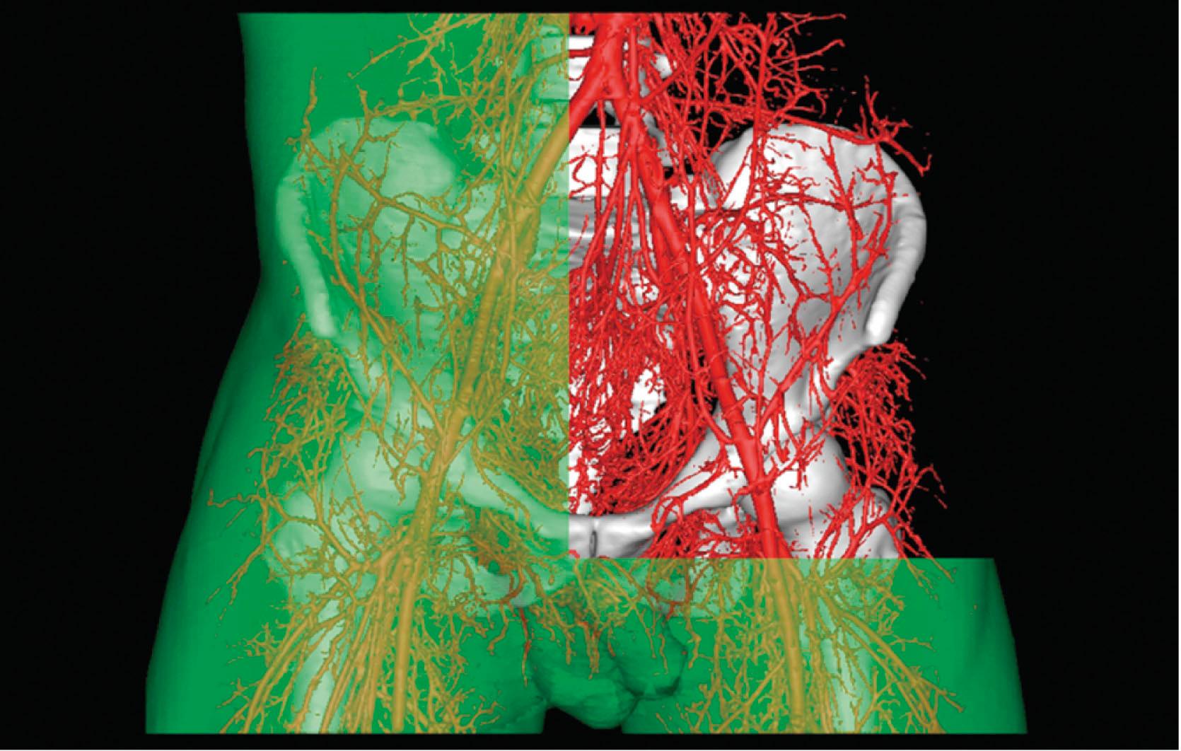 Figure 23.9, Computed tomography angiography of a cadaver pelvis, showing bony, vascular, and skin three-dimensional anatomy. Using MIMICS software, the various anatomic structures can be included or removed.