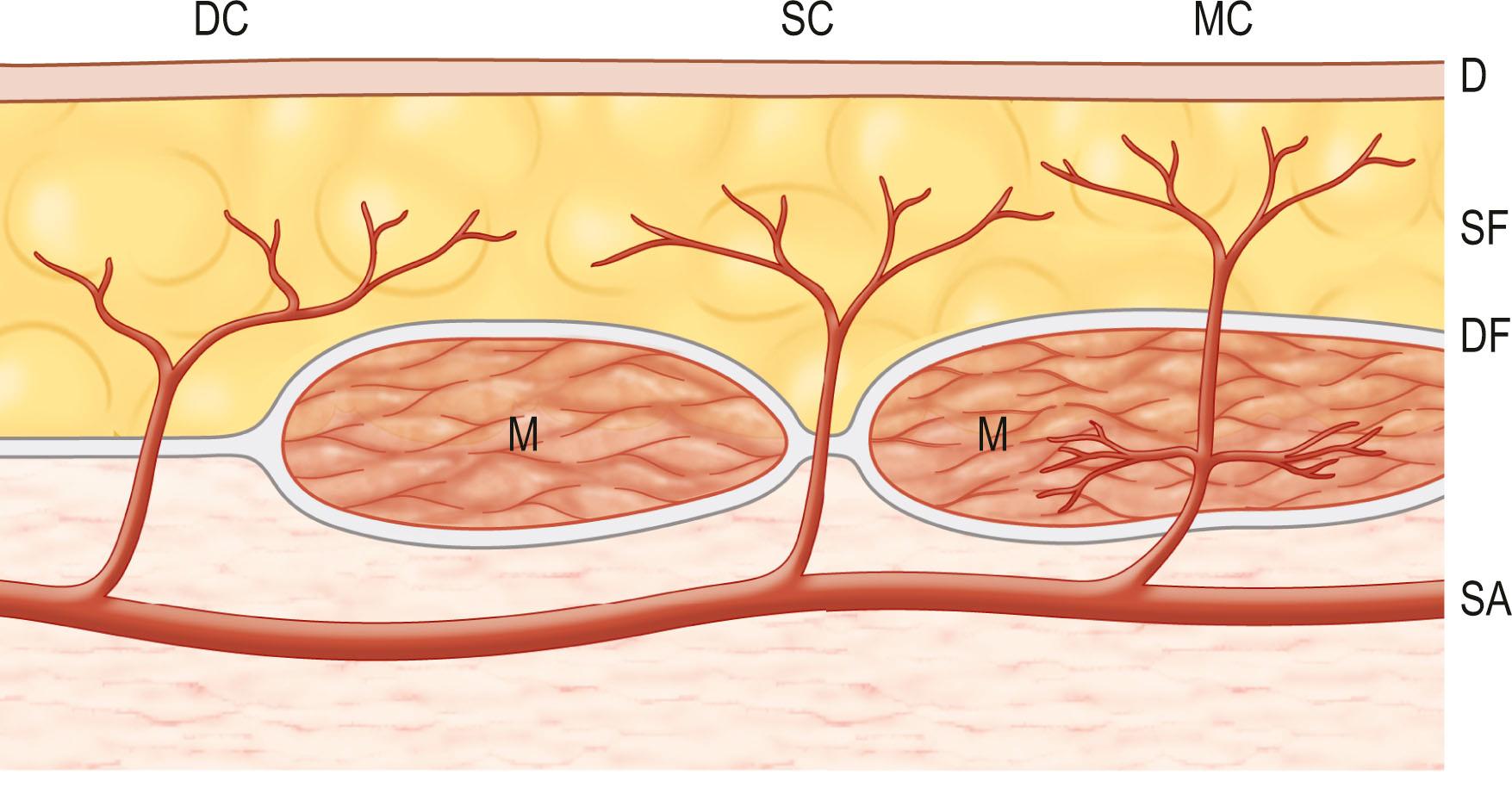 Figure 23.11, Schematic illustration of direct and indirect cutaneous vessels. D, Dermis; DC, direct cutaneous; DF, deep fascia; M, muscle; MC, musculocutaneous; SA, source artery; SC, septocutaneous; SF, superficial dermis.