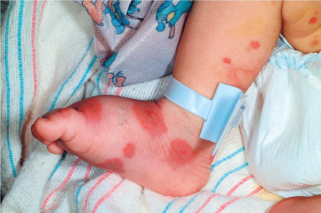 Fig. 21.12, Acute hemorrhagic edema of infancy. Multiple purpuric papules and plaques in the same patient shown in Fig. 21.11 .