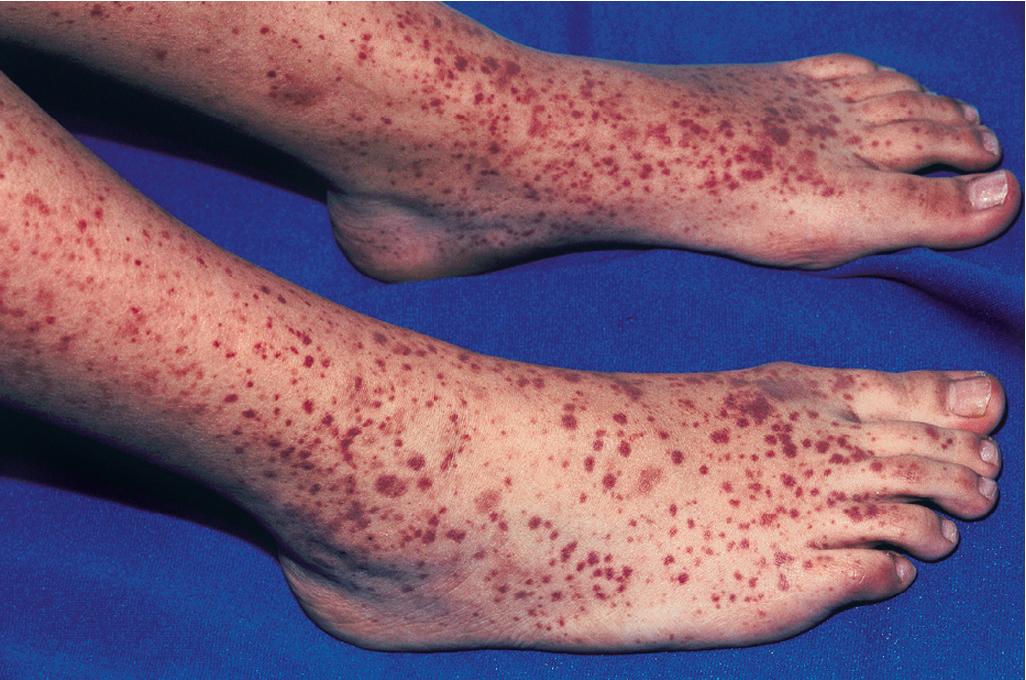 Fig. 21.13, Hypersensitivity vasculitis (HV). Multiple purpuric papules in an adolescent girl with a drug-induced HV.