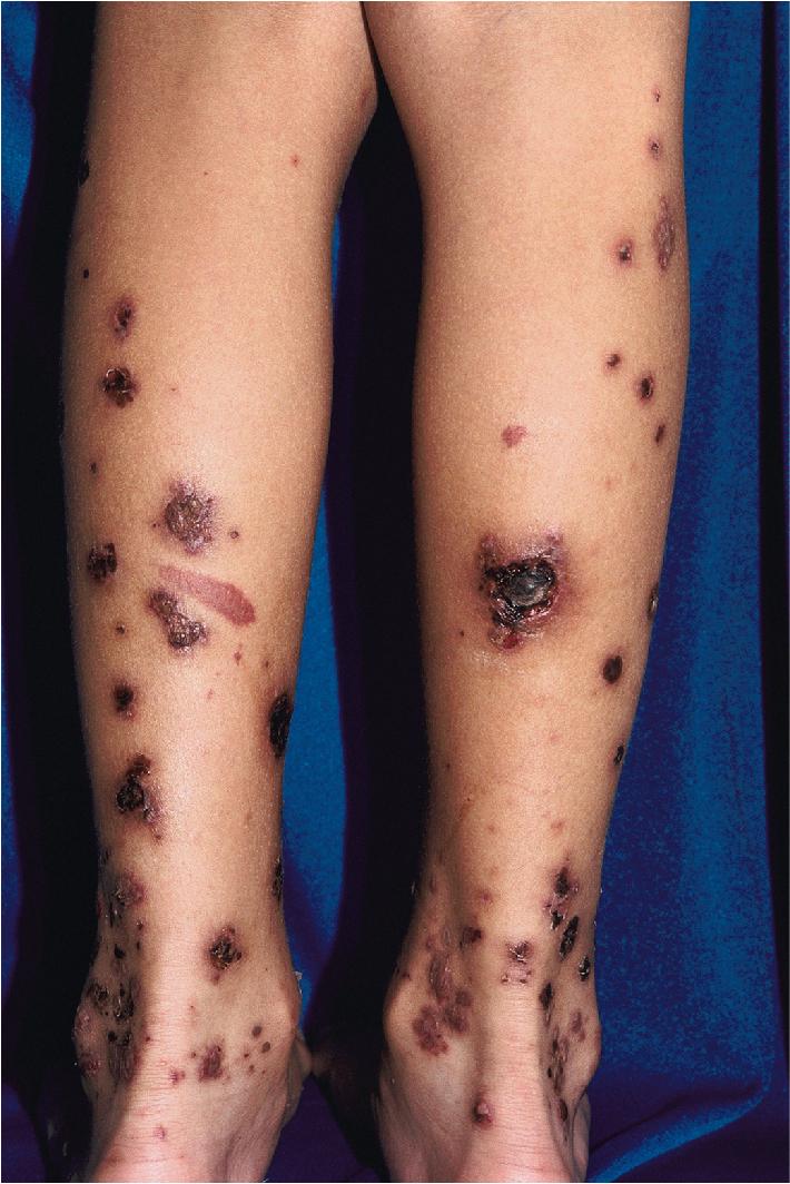 Fig. 21.4, Henoch–Schönlein purpura. These purpuric plaques became bullous with subsequent necrosis.