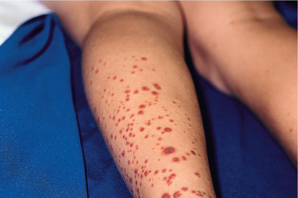 Fig. 21.3, Henoch–Schönlein purpura. Palpable purpuric papules and plaques.