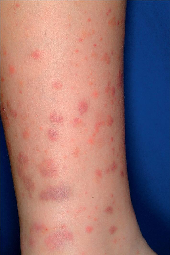 Fig. 21.2, Henoch–Schönlein purpura. Urticarial, purpuric papules and plaques on the lower extremity.