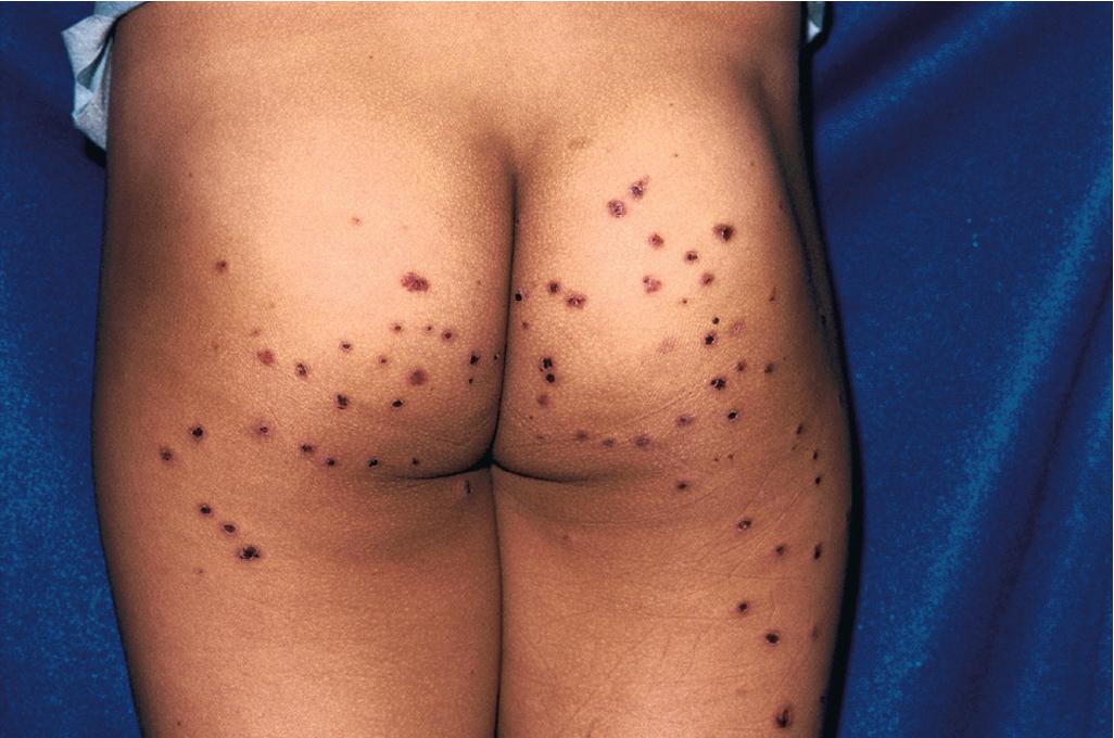 Fig. 21.5, Henoch–Schönlein purpura (HSP). Palpable purpura of the buttocks, a classic site of involvement in HSP.