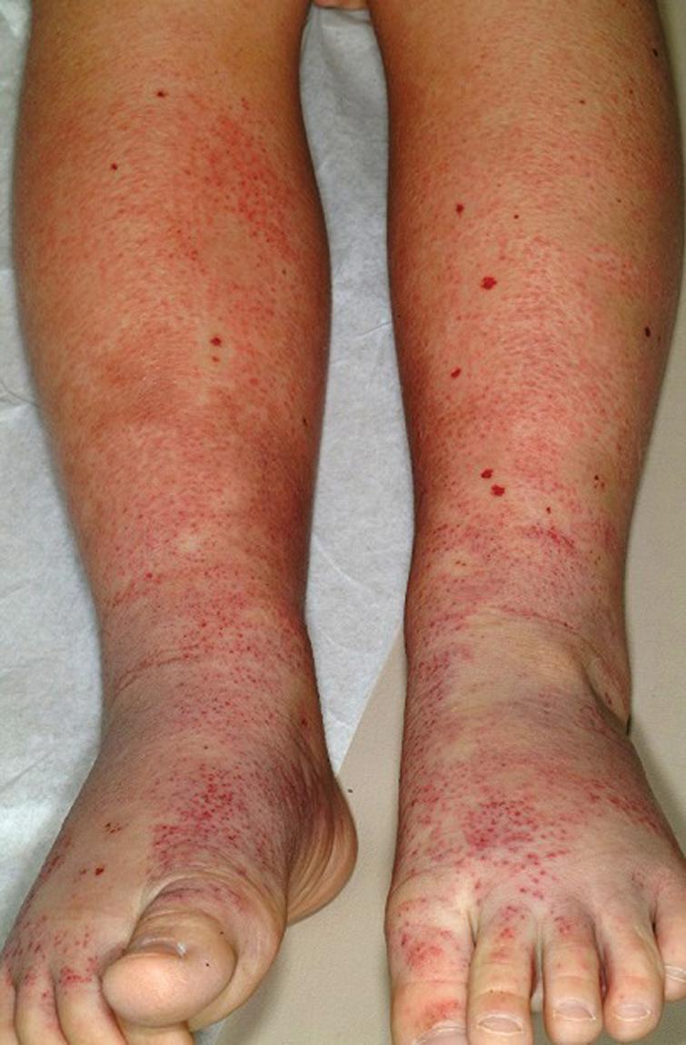 Fig. 21.6, Henoch–Schönlein purpura. This 4-year-old boy developed numerous petechiae with scattered purpuric nonblanchable papules on the feet, lower legs and buttocks 2 weeks after upper respiratory infection.