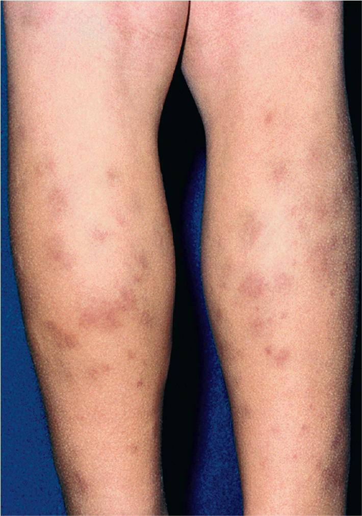 Fig. 21.7, Henoch–Schönlein purpura. Occasionally, patients have ecchymotic (bruise-like) lesions without classic purpura, as in this 9-year-old boy.