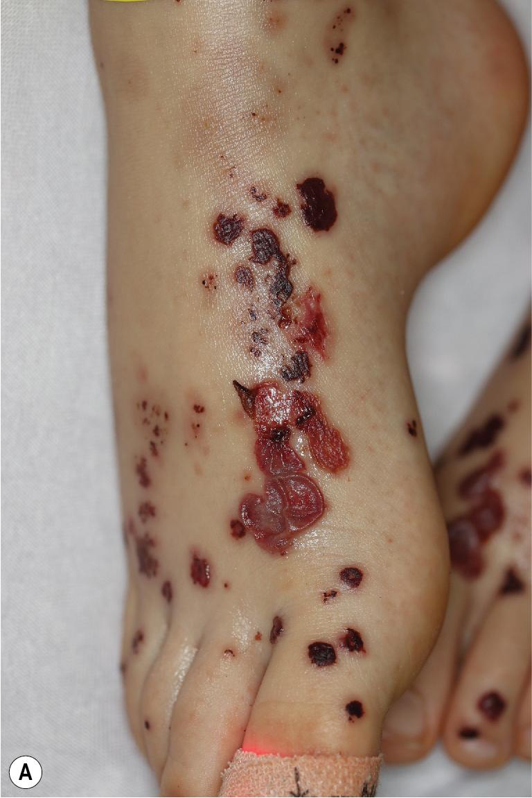 Fig. 21.8, Bullous Henoch-Schönlein purpura (HSP). This 6-year-old boy presented with palpable purpura with bullae and necrosis in a diffuse distribution (including the feet (A) and hands (B) as shown here), along with joint pain, abdominal pain with intussusception, nephritis, and hypertension.